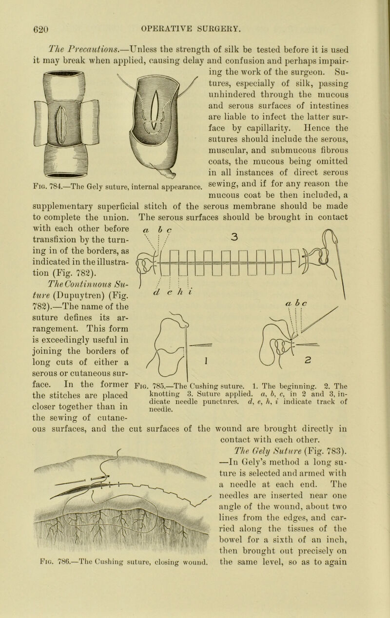 The Precautions.—Unless the strength of silk be tested before it is used it may break when applied, causing delay and confusion and perhaps impair- ing the work of the surgeon. Su- tures, esj)ecially of silk, joassing unhindered through the mucous and serous surfaces of intestines are liable to infect the latter sur- face by capillarity. Hence the sutures should include the serous, muscular, and submucous fibrous coats, the mucous being omitted in all instances of direct serous Fig. 784.—The Gely suture, internal appearance, sewing, and if foi any leason the mucous coat be then included, a supplementary superficial stitch of the serous membrane should be made to complete the union, with each other before transfixion by the turn- ing in of the borders, as indicated in the illustra- tion (Fig. 782). TheContinuous Su- ture (Dupuytren) (Fig. 782).—The name of the suture defines its ar- rangement. This form is exceedingly useful in joining the borders of long cuts of either a serous or cutaneous sur- face. In the former the stitches are placed closer together than in the sewing of cutane- ous surfaces, and the cut surfaces of the wound are brought directly in contact with each other. The Gely Suture (Fig. 783). —In Gely’s method a long su- ture is selected and armed with a needle at each end. The needles are inserted near one angle of the wound, about two lines from the edges, and car- ried along the tissues of the bowel for a sixth of an inch, then brought out precisely on Fig. 780.—The Ciisliing suture, closing wound. the same level, SO as to again The serous surfaces should be brought in contact CV he /TV Fig. 785.—The Cushing suture. 1. The beginning. 2. The knotting 3. Suture applied, a. b, c, in 2 and 3, in- dicate needle punctures, d, e, h, i indicate track of needle.