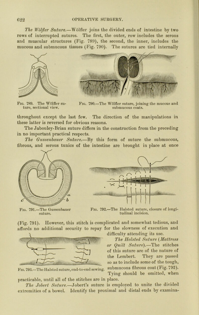 The Wolfler Suttire.—Wolfler joins the divided ends of intestine by two rows of interrupted sutures. The first, the outer, row includes the serous and muscular structures (Fig. 789), the second, the inner, includes the mucous and submucous tissues (Fig. 790). The sutures are tied internally Fig. 789. The Wolfler su- ture, sectional view. Fig. 790.—The Wolfler suture, joining the mucous and submucous coats. throughout except the last few. The direction of the manipulations in these latter is reversed for obvious reasons. The Jabouley-Briau suture differs in the construction from the preceding in no important practical respects. The Oussenhauer Suture.—By this form of suture the submucous, fibrous, and serous tunics of the intestine are brought in place at once Fig. 791.—The Gussenbauer suture. Fig. 792.—The Ilalsted suture, closure of longi- tudinal incision. (Fig. 791). However, this stitch is complicated and somewhat tedious, and affords no additional security to repay for the slowness of execution and difficulty attending its use. The Hals ted Suture {Mattress or Quilt Suture).—The stitches of this suture are of the nature of the Lernbert. They are passed so as to include some of the tough, -TlieIlalsted suture, end-to-end sewing, submucous fibrous COat (Fig. <92). Tying should be omitted, when practicable, until all of the stitches are in place. The Johert Suture.—Jobert’s suture is employed to unite the divided extremities of a bowel. Identify the proximal and distal ends by examina- Fig. 793.