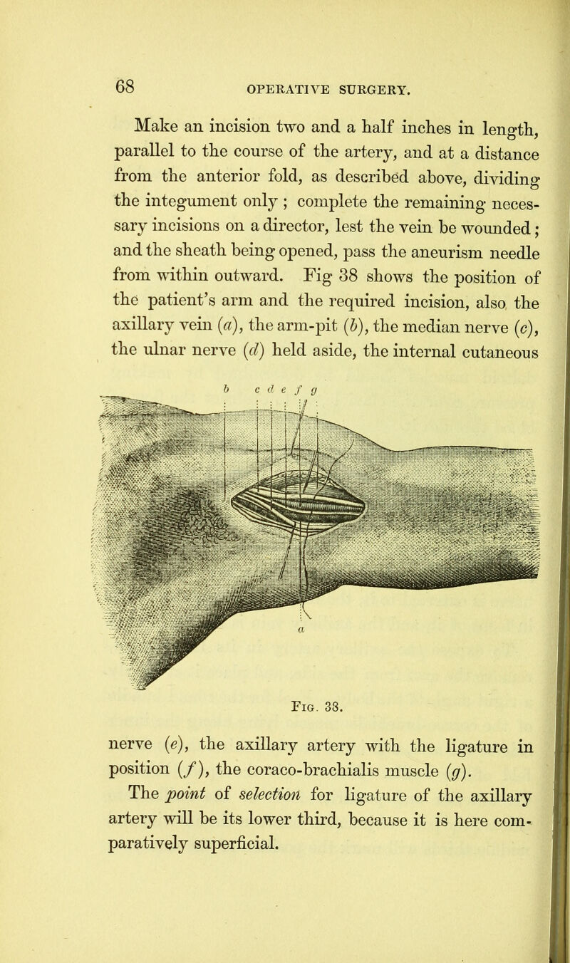 Make an incision two and a half inches in length, parallel to the course of the artery, and at a distance from the anterior fold, as described above, dividing the integument only ; complete the remaining neces- sary incisions on a director, lest the vein be wounded; and the sheath being opened, pass the aneurism needle from within outward. Fig 38 shows the position of the patient's arm and the required incision, also the axillary vein (a), the arm-pit (b), the median nerve (c), the ulnar nerve (d) held aside, the internal cutaneous b c d e f g Fig. 33. nerve (e), the axillary artery with the ligature in position (/), the coraco-brachialis muscle (g). The point of selection for ligature of the axillary artery will be its lower third, because it is here com- paratively superficial.