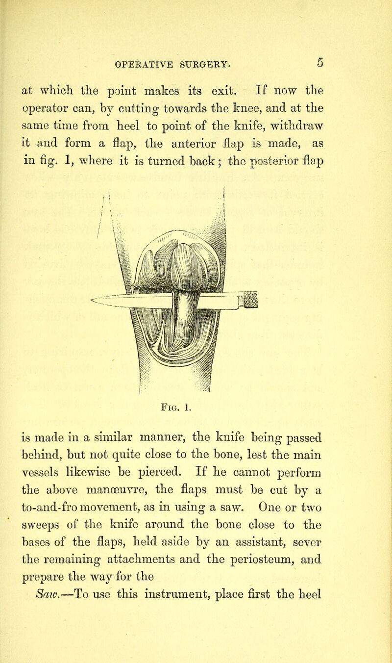 at which the point makes its exit. If now the operator can, by cutting towards the knee, and at the same time from heel to point of the knife, withdraw it and form a flap, the anterior flap is made, as in fig. I, where it is turned back ; the posterior flap Fig. 1. is made in a similar manner, the knife being passed behind, but not quite close to the bone, lest the main vessels likewise be pierced. If he cannot perform the above manoeuvre, the flaps must be cut by a to-and-fro movement, as in using a saw. One or two sweeps of the knife around the bone close to the bases of the flaps, held aside by an assistant, sever the remaining attachments and the periosteum, and prepare the way for the Saw.—To use this instrument, place first the heel