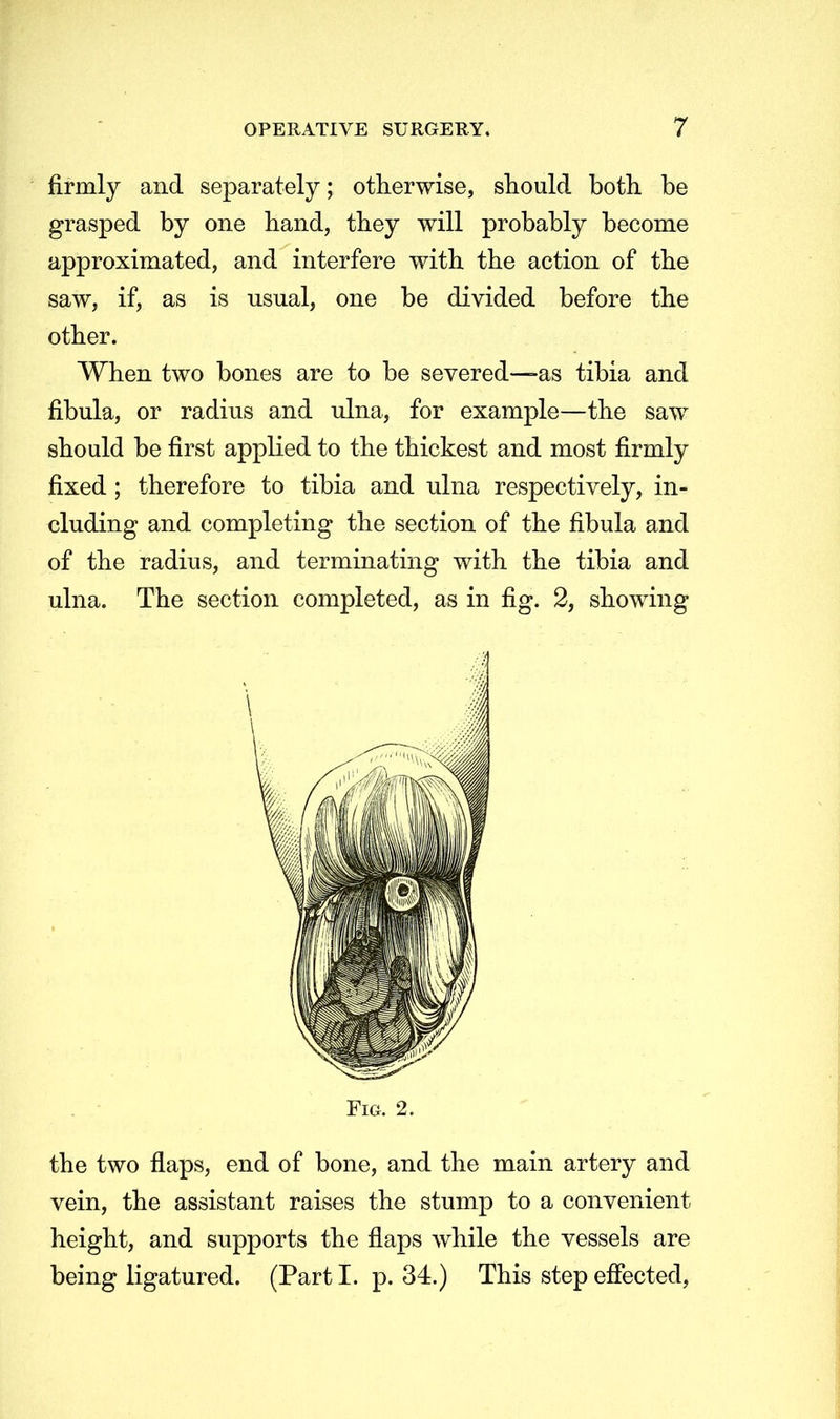 firmly and separately; otherwise, should both be grasped by one hand, they will probably become approximated, and interfere with the action of the saw, if, as is usual, one be divided before the other. When two bones are to be severed—as tibia and fibula, or radius and ulna, for example—the saw should be first applied to the thickest and most firmly fixed ; therefore to tibia and ulna respectively, in- cluding and completing the section of the fibula and of the radius, and terminating with the tibia and ulna. The section completed, as in fig. 2, showing Fig. 2. the two flaps, end of bone, and the main artery and vein, the assistant raises the stump to a convenient height, and supports the flaps while the vessels are being ligatured. (Part I. p. 34.) This step effected,