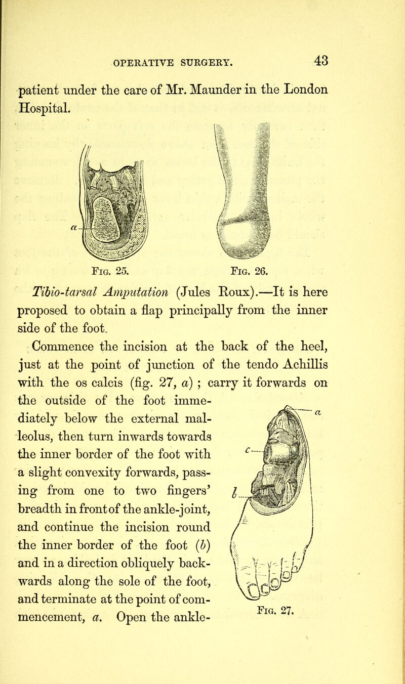 patient under the care of Mr. Maunder in the London Hospital. Fig. 25. Fig. 26. Tibio-tarsal Amputation (Jules Roux).—It is here proposed to obtain a flap principally from the inner side of the foot. Commence the incision at the back of the heel, just at the point of junction of the tendo Achillis with the os calcis (fig. 27, a) ; carry it forwards on the outside of the foot imme- diately below the external mal- leolus, then turn inwards towards the inner border of the foot with a slight convexity forwards, pass- ing from one to two fingers' breadth in front of the ankle-joint, and continue the incision round the inner border of the foot (b) and in a direction obliquely back- wards along the sole of the foot, and terminate at the point of com- mencement, a. Open the ankle-