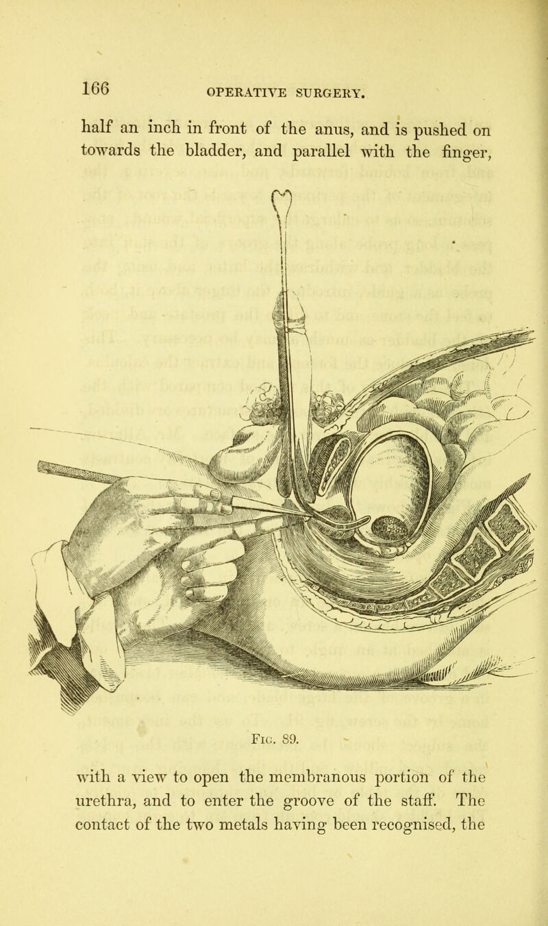half an inch in front of the anus, and is pushed on towards the bladder, and parallel with the finger, Fig. 89. with a view to open the membranous portion of the urethra, and to enter the groove of the staff. The contact of the two metals having been recognised, the