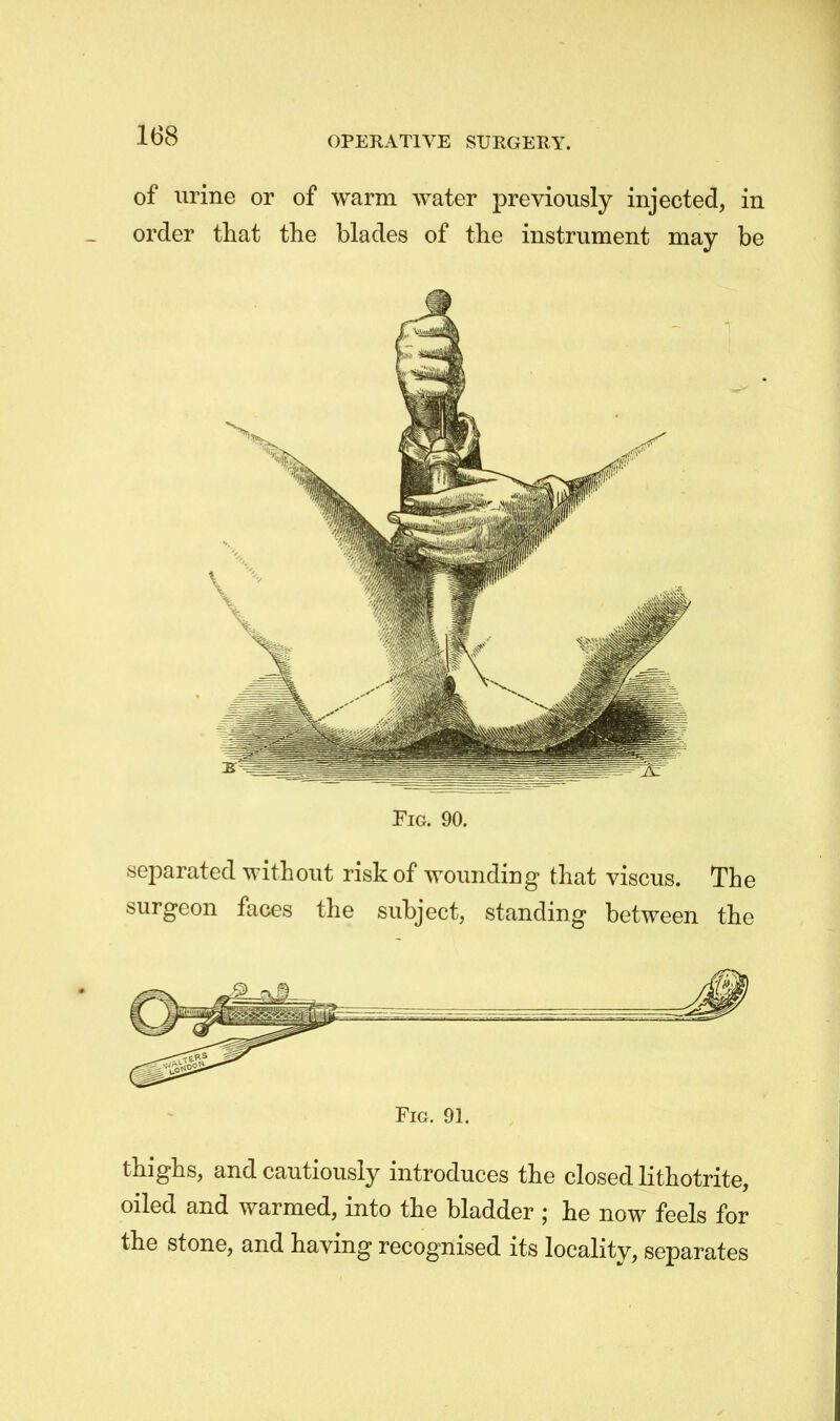 of urine or of warm water previously injected, in order that the blades of the instrument may be Fig. 90. separated without risk of wounding that viscus. The surgeon faces the subject, standing between the Fig. 91. thighs, and cautiously introduces the closed lithotrite, oiled and warmed, into the bladder ; he now feels for the stone, and having recognised its locality, separates