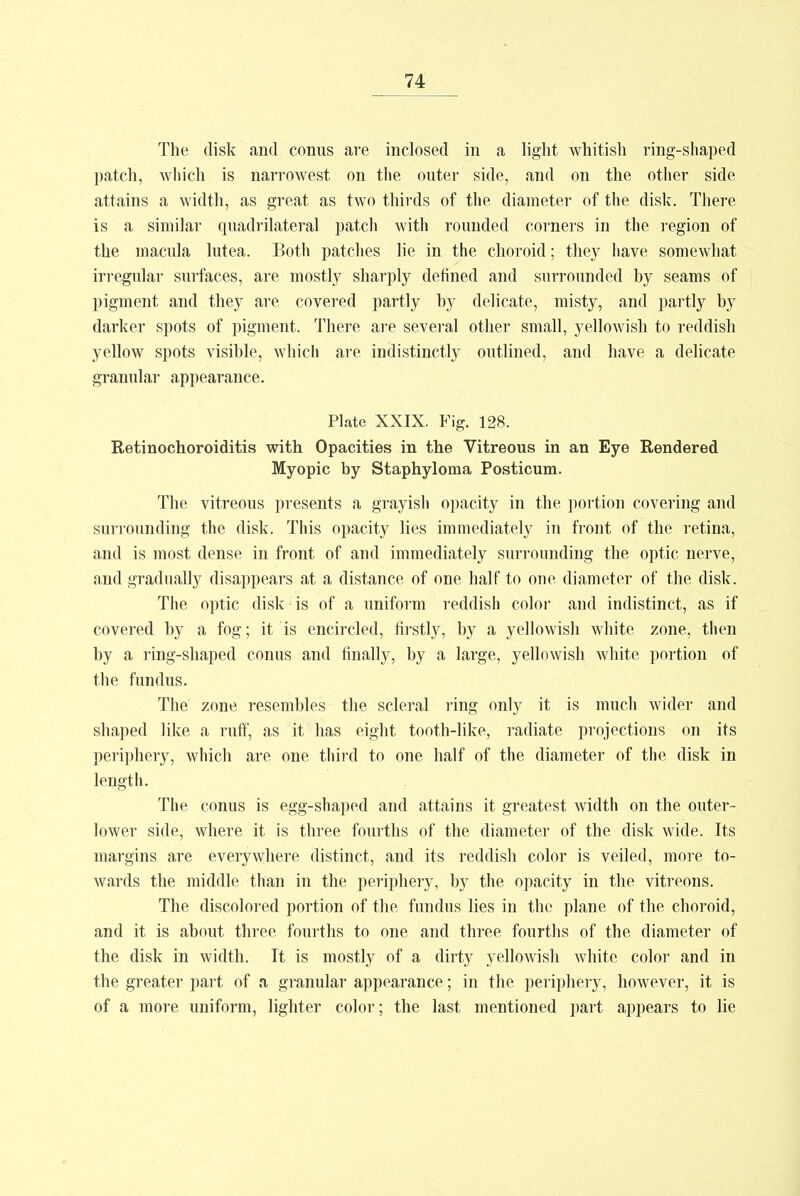 The disk and conns are inclosed in a light whitish ring-shaped patch, which is narrowest on the outer side, and on the other side attains a width, as great as two thirds of the diameter of the disk. There is a similar quadrilateral patch with rounded corners in the region of the macula lutea. Both patches lie in the choroid; they have somewhat irregular surfaces, are mostly sharply defined and surrounded hy seams of pigment and they are covered partly hy delicate, misty, and partly hy darker spots of pigment. There are several other small, yellowish to reddish yellow spots visible, which are indistinctly outlined, and have a delicate granular appearance. Plate XXIX. Fig. 128. Retinochoroiditis with Opacities in the Vitreous in an Eye Rendered Myopic by Staphyloma Posticum. The vitreous presents a grayish opacity in the portion covering and surrounding the disk. This opacity lies immediately in front of the retina, and is most dense in front of and immediately surrounding the optic nerve, and gradually disappears at a distance of one half to one diameter of the disk. The optic disk is of a uniform reddish color and indistinct, as if covered hy a fog; it is encircled, firstly, by a yellowish white zone, then by a ring-shaped conns and finally, by a large, yellowish white portion of the fundus. The zone resembles the scleral ring only it is much wider and shaped like a ruff, as it has eight tooth-like, radiate projections on its periphery, which are one third to one half of the diameter of the disk in length. The conus is egg-shaped and attains it greatest width on the outer- lower side, where it is three fourths of the diameter of the disk wide. Its margins are everywhere distinct, and its reddish color is veiled, more to- wards the middle than in the periphery, by the opacity in the vitreons. The discolored portion of the fundus lies in the plane of the choroid, and it is about three fourths to one and three fourths of the diameter of the disk in width. It is mostly of a dirty yellowish white color and in the greater part of a granular appearance; in the periphery, however, it is of a more uniform, lighter color; the last mentioned part appears to lie