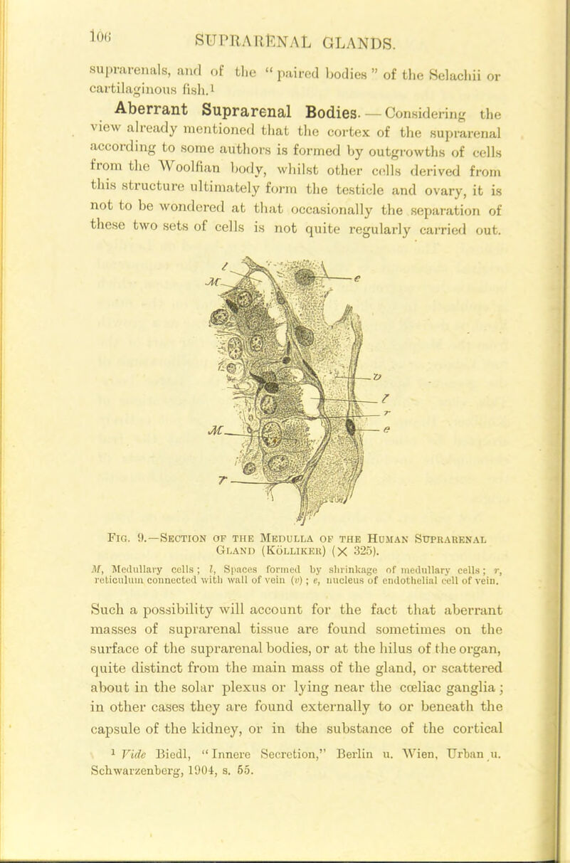 suprarenals, aiul of the  pairod Ijodies  of tlie Helacl.ii or cartilaginous fish.i Aberrant Suprarenal Bodies. — Considering the view already mentioned that the cortex of the suprarenal according to some authors is formed by outgrowths of cells from the Woolfian body, wliilst other c.ills derived from this structure ultimately form the testicle and ovary, it is not to be wondered at that occasionally the separation of these two sets of cells is not quite regularly carried out. Fig. 9.—Section of the Medulla or the Hdiian StrpRARKNAL Gland (Kollikf.k) (X 325). M, Mcilullaiy cells; I, Spaces fornieil by slii inkage of medullary cells; r, l uliculuin connected v. itli wall of vein (i') ; e, nucleus of endothelial (ell of vein. Such a possibility will account for the fact that aberrant masses of suprarenal tissue are found sometimes on the surface of the suprarenal bodies, or at the hilus of the organ, quite distinct from the main mass of the gland, or scattered about in the solar plexus or lying near the cceliac ganglia; in other cases they are found externally to or beneath the capsule of the kidney, or in the substance of the cortical 1 Fide Biedl,  Innere Secretion, Berlin u. Wien, Urban _u. Schwarzenberg, 1904, s. 65.