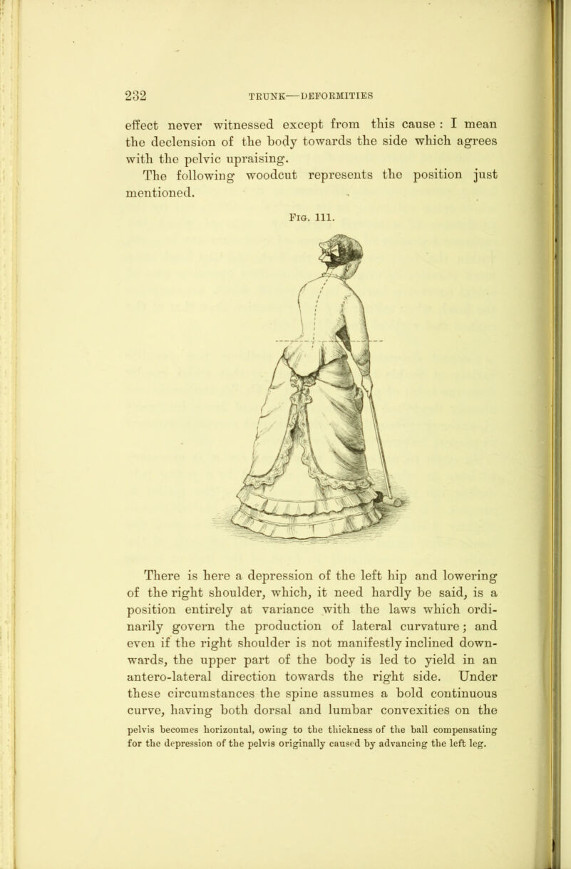 effect never witnessed except from this cause : I mean the declension of the body towards the side which agrees with the pelvic upraising. The following woodcut represents the position just mentioned. Fig. 111. There is here a depression of the left hip and lowering of the right shoulder, which, it need hardly be said, is a position entirely at variance with the laws which ordi- narily govern the production of lateral curvature; and even if the right shoulder is not manifestly inclined down- wards, the upper part of the body is led to yield in an antero-lateral direction towards the right side. Under these circumstances the spine assumes a bold continuous curve, having both dorsal and lumbar convexities on the pelvis becomes horizontal, owing to the thickness of the ball compensating for the depression of the pelvis originally caused by advancing the left leg.