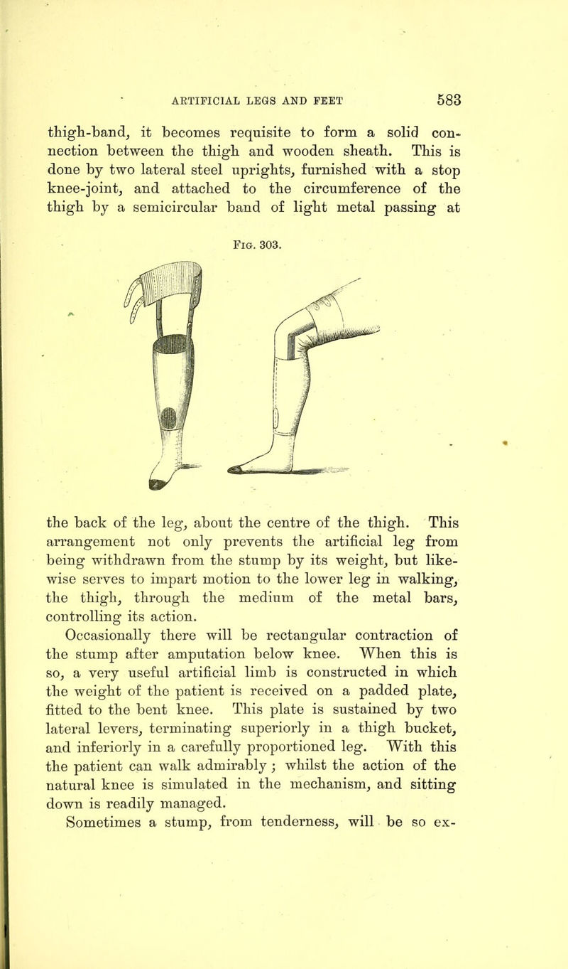 thigh-band, it becomes requisite to form a solid con- nection between the thigh and wooden sheath. This is done by two lateral steel uprights, furnished with a stop knee-joint, and attached to the circumference of the thigh by a semicircular band of light metal passing at Fig. 303. the back of the leg, about the centre of the thigh. This arrangement not only prevents the artificial leg from being withdrawn from the stump by its weight, but like- wise serves to impart motion to the lower leg in walking, the thigh, through the medium of the metal bars, controlling its action. Occasionally there will be rectangular contraction of the stump after amputation below knee. When this is so, a very useful artificial limb is constructed in which the weight of the patient is received on a padded plate, fitted to the bent knee. This plate is sustained by two lateral levers, terminating superiorly in a thigh bucket, and interiorly in a carefully proportioned leg. With this the patient can walk admirably ; whilst the action of the natural knee is simulated in the mechanism, and sitting down is readily managed. Sometimes a stump, from tenderness, will be so ex-