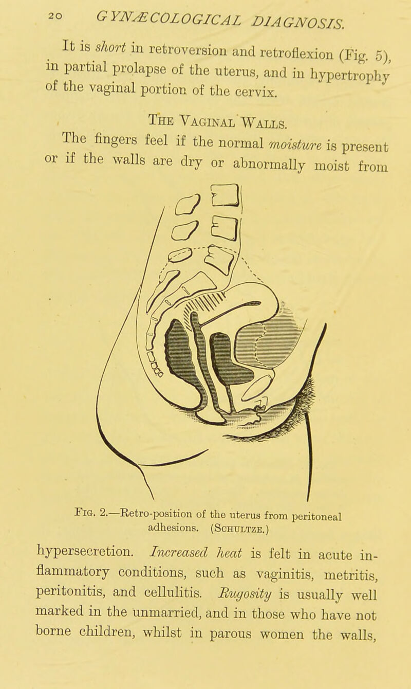 It is short in retroversion and retroflexion (Fig 5) m partial prolapse of the uterus, and in hypertrophy of the vaginal portion of the cervix. The Vaginal Walls. The fingers feel if the normal moisture is present or if the walls are dry or abnormally moist from Fig. 2.—^Retro-position of the uterus from peritoneal adhesions. (Schultze.) hypersecretion. Increased heat is felt in acute in- flammatory conditions, such as vaginitis, metritis, peritonitis, and cellulitis. Rugosity is usually well marked in the unmarried, and in those who have not borne children, whilst in parous women the walls,