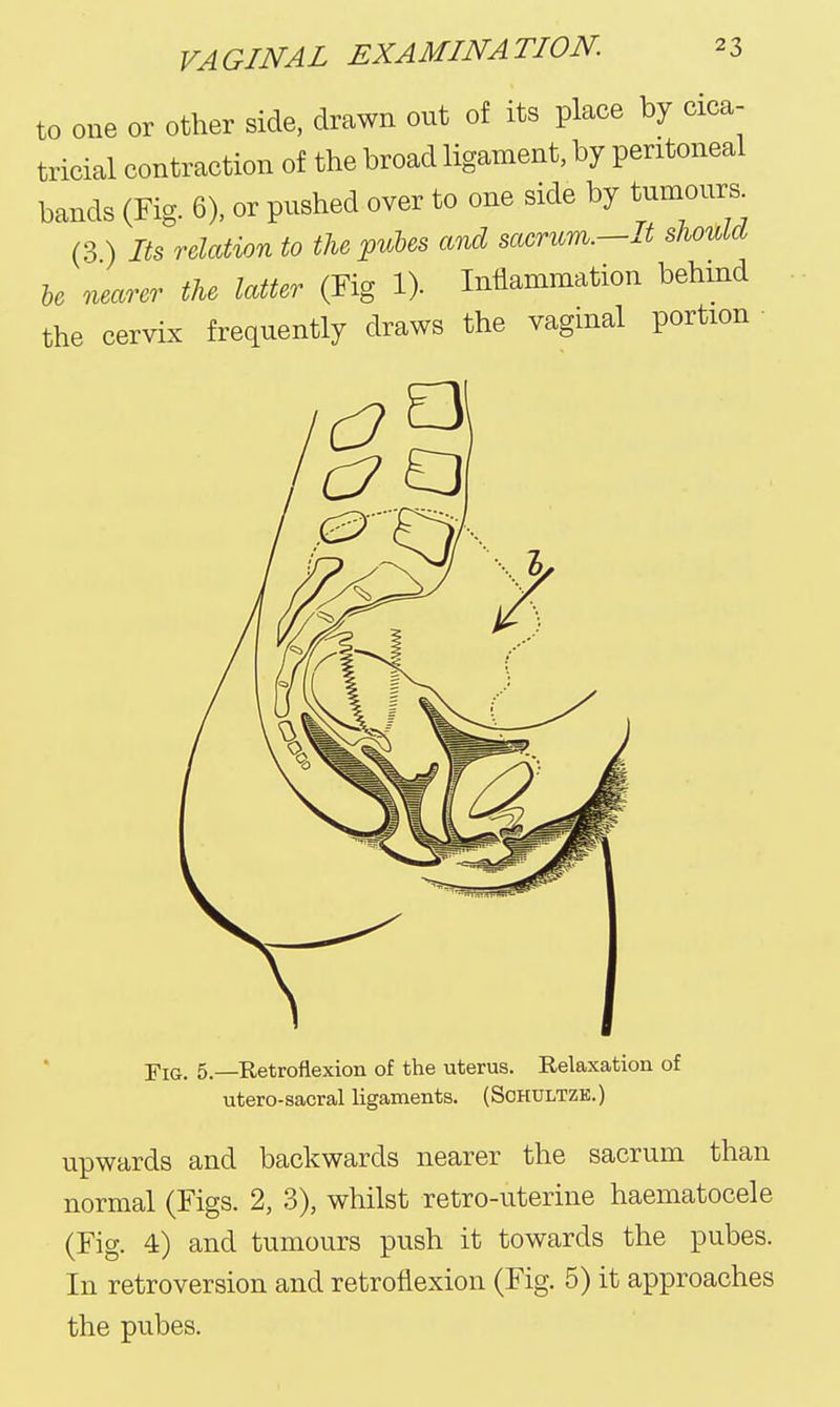 to one or other side, drawn out of its place by cica- tricial contraction of the broad ligament, by peritoneal bands (Fig. 6), or pushed over to one side by tumours^ (3 ) Its relation to the puhes and sacrum.—It should he nearer the latter (Fig 1). Inflammation behmd the cervix frequently draws the vagmal portion -pia. 5.—Retroflexion of the uterus. Relaxation of utero-sacral ligaments. (ScHULTZE.) upwards and backwards nearer the sacrum than normal (Figs. 2, 3), whilst retro-uterine haematocele (Fig. 4) and tumours push it towards the pubes. In retroversion and retroflexion (Fig. 5) it approaches the pubes.