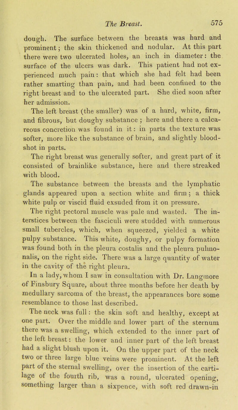 dough. The surface between the breasts was hard and prominent; the skin thickened and nodular. At this part there were two ulcerated holes, an inch in diameter: the surface of the ulcers was dark. This patient had not ex- perienced much pain: that which she had felt had been rather smarting than pain, and had been confined to the right breast and to the ulcerated part. She died soon after her admission. The left breast (the smaller) was of a hard, white, firm, and fibrous, but doughy substance ; here and there a calca- reous concretion was found in it: in parts the texture was softer, more like the substance of brain, and slightly blood- shot in parts. The right breast was generally softer, and great part of it consisted of brainlike substance, here and there streaked with blood. The substance between the breasts and the lymphatic glands appeared upon a section white and firm ; a thick white pulp or viscid fluid exsuded from it on pressure. The right pectoral muscle was pale and wasted. The in- terstices between the fasciculi were studded with numerous small tubercles, which, when squeezed, yielded a white pulpy substance. This white, doughy, or pulpy formation was found both in the pleura costalis and the pleura pulino- nalis, on the right side. There was a large quantity of water in the cavity of the right pleura. In a lady, whom I saw in consultation with Dr. Langmore of Finsbury Square, about three months before her death by medullary sarcoma of the breast, the appearances bore some resemblance to those last described. The neck was full: the skin soft and healthy, except at one part. Over the middle and lower part of the sternum there was a swelling, which extended to the inner part of the left breast: the lower and inner part of the left breast had a slight blush upon it. On the upper part of the neck two or three large blue veins were prominent. At the left part of the sternal swelling, over the insertion of the carti- lage of the fourth rib, was a round, ulcerated opening, something larger than a sixpence, with soft red drawn-in
