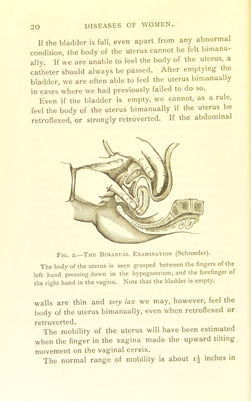 If the bladder is full, even apart from any abnormal condition, the body of the uterus cannot be felt bimanu- ally. If we are unable to feel the body of the uterus, a catheter should always be passed. After emptying the bladder, we are often able to feel the uterus bimanually in cases where we had previously failed to do so. Even if the bladder is empty, we cannot, as a rule, feel the body of the uterus bimanually if the uterus be retroflexed, or strongly retroverted. If the abdominal Fig. 2.—The Bimanual Examination (Schroeder). The body of the uterus is seen grasped between the fingers of the left hand pressing down in the hypogastrium, and the forefinger of the riglit hand in the vagina. Note that the bladder is empty. walls are thin and very lax we may, however, feel the body of the uterus bimanually, even when retroflexed or retroverted. The mobility of the uterus will have been estimated when the finger in the vagina made the upward tilting movement on the vaginal cervix. The normal range of mobility is about inches m