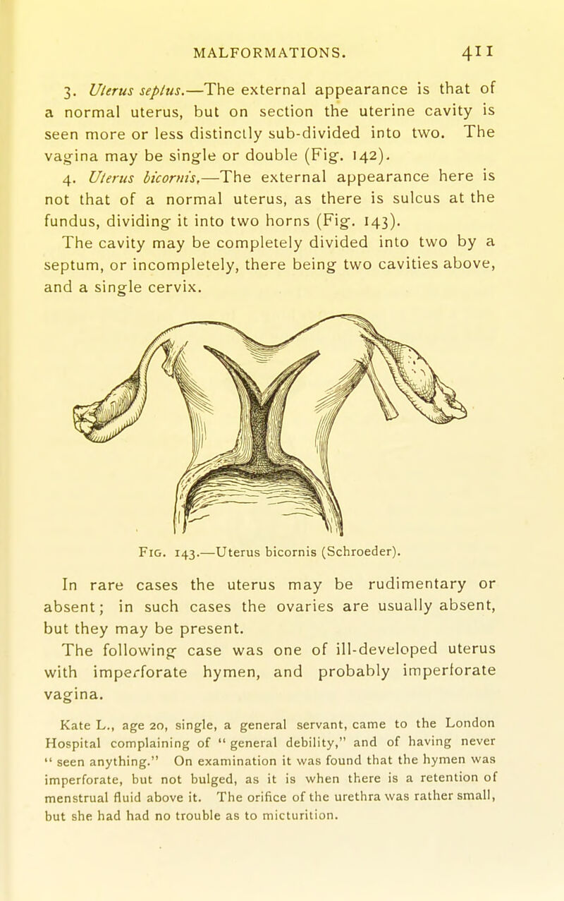 3. Uterus septus.—The external appearance is that of a normal uterus, but on section the uterine cavity is seen more or less distinctly sub-divided into two. The vagina may be single or double (Fig. 142), 4. Uterus bicornis,—The external appearance here is not that of a normal uterus, as there is sulcus at the fundus, dividing it into two horns (Fig. 143). The cavity may be completely divided into two by a septum, or incompletely, there being two cavities above, and a single cervix. In rare cases the uterus may be rudimentary or absent; in such cases the ovaries are usually absent, but they may be present. The following case was one of ill-developed uterus with imperforate hymen, and probably imperforate vagina. Kate L., age 20, single, a general servant, came to the London Hospital complaining of  general debility, and of having never  seen anything. On examination it was found that the hymen was imperforate, but not bulged, as it is when there is a retention of menstrual fluid above it. The orifice of the urethra was rather small, but she had had no trouble as to micturition.