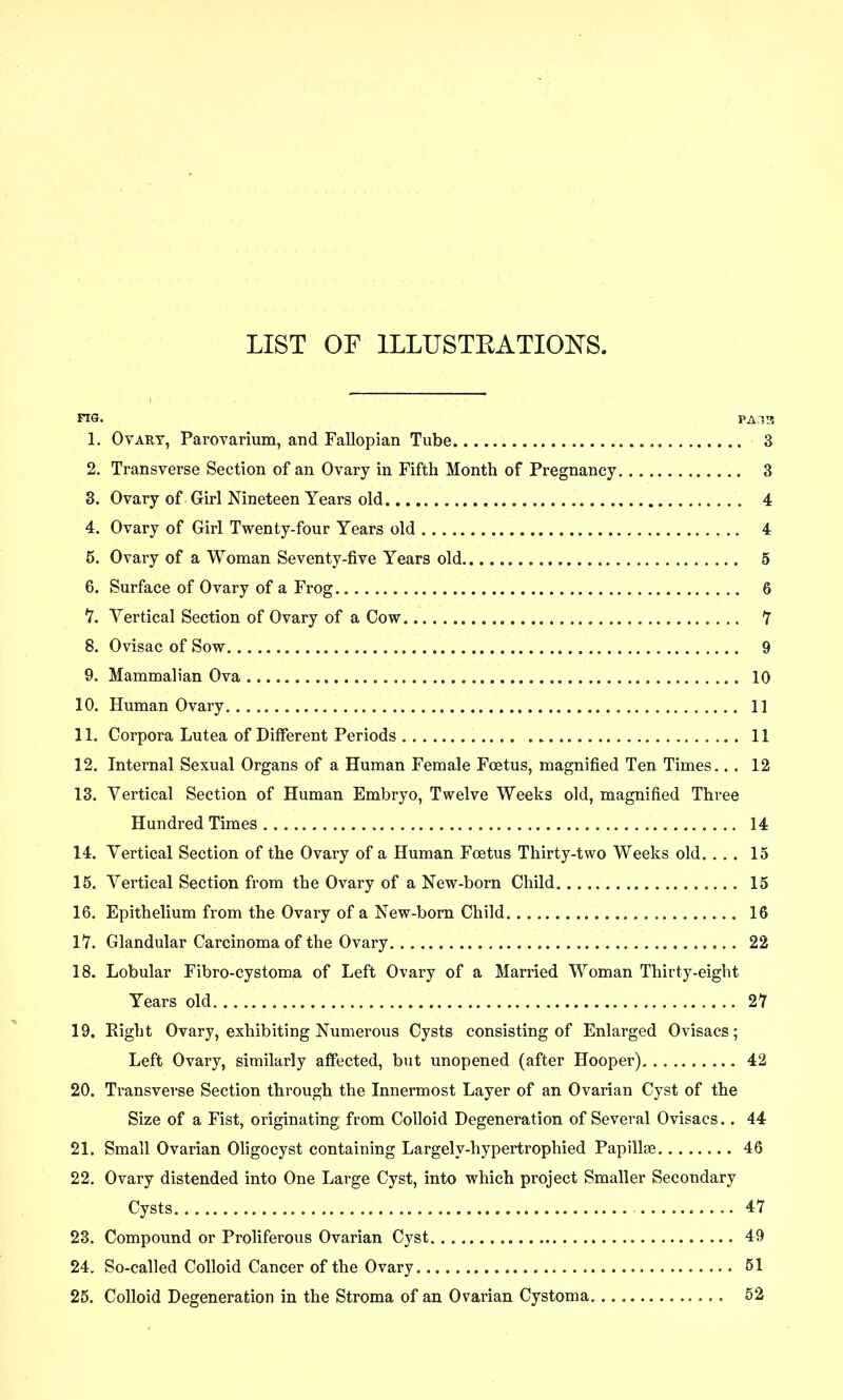 LIST OF ILLUSTEATIOI^S. FIG. PAl?. 1. Ovary, Parovarium, and Fallopian Tube 3 2. Transverse Section of an Ovary in Fifth Month of Pregnancy 3 3. Ovary of Girl Nineteen Years old 4 4. Ovary of Girl Twenty-four Years old 4 5. Ovary of a Woman Seventy-five Years old 5 6. Surface of Ovary of a Frog 6 7. Vertical Section of Ovary of a Cow 7 8. Ovisac of Sow 9 9. Mammalian Ova 10 10. Human Ovary 11 11. Corpora Lutea of Different Periods . . 11 12. Internal Sexual Organs of a Human Female Foetus, magnified Ten Times.. . 12 13. Vertical Section of Human Embryo, Twelve Weeks old, magnified Three Hundred Times 14 14. Vertical Section of the Ovary of a Human Foetus Thirty-two Weeks old. . . . 15 15. Vertical Section from the Ovary of a New-born Child. , 15 16. Epithelium from the Ovary of a New-born Child 16 17. Glandular Carcinoma of the Ovary 22 18. Lobular Fibro-cystoma of Left Ovary of a Married Woman Thirty-eight Years old 27 19. Right Ovary, exhibiting Numerous Cysts consisting of Enlarged Ovisacs; Left Ovary, similarly affected, but unopened (after Hooper) 42 20. Transverse Section through the Innermost Layer of an Ovarian Cyst of the Size of a Fist, originating from Colloid Degeneration of Several Ovisacs. . 44 21. Small Ovarian Oligocyst containing Largely-hypertrophied Papillae 46 22. Ovary distended into One Large Cyst, into which project Smaller Secondary Cysts 47 23. Compound or Proliferous Ovarian Cyst 49 24. So-called Colloid Cancer of the Ovary 51 25. Colloid Degeneration in the Stroma of an Ovarian Cystoma 52