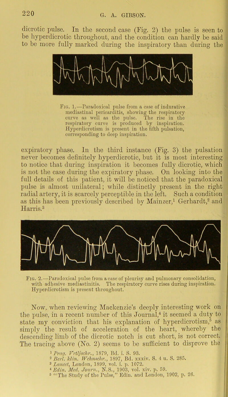 dicrotic pulse. In the second case (Fig. 2) the pulse is seen to he hyperdicrotic throughout, and the condition can hardly be said to be more fully marked during the inspiratory than during the Fig. 1.—Paradoxical pulse from a case of indurative mediastinal pericarditis, showing the respiratory curve as w'ell as the pulse. The rise in tlie rcspiratoiy curve is produced by inspiration. Ilypcrdicrotism is present in the liftli pulsation, corresponding to deep inspiration. expiratory phase. In the third instance (Fig. 3) the pulsation never becomes definitely hyperdicrotic, hut it is most interesting to notice that during inspiration it becomes fully dicrotic, which is not tlie case during the expiratory phase. On looking into the full details of this patient, it will he noticed that the paradoxical pulse is almost unilateral; while distinctly present in the right radial artery, it is scarcely perceptible in the left. Such a condition as this has been previously described by Mainzer,^ Gerhardt,^ and Harris.^ Fig. 2.—Paradoxical pulse from a case of pleurisy and pulmonary consolidation, with adhesive mediastinitis. The respiratory curve rises during inspii’ation. Hyperdicrotism is iiresent throughout. Now, when reviewing Mackenzie’s deeply interesting work on the pulse, in a recent number of this Journal,^ it seemed a duty to state my conviction that his explanation of hyperdicrotism,® as simply the result of acceleration of the heart, whereby the descending limb of the dicrotic notch is cut short, is not correct. The tracing above (No. 2) seems to bo sufficient to disprove the > Praff. Vrtljschr., 1879, Bd. i. S. 93. - Berl. Min. Wchnschr., 1897, Bd. xxxiv. S. 4 u. S. 285. ^ Lanccl, London, 1899, vol. i. ]i. 1072. * Edin. Med. Joitrn., N.S., 1903, vol. xiv. p. 59. “ “The Study of the Pulse,” Edin. and London, 1902, p. 26.