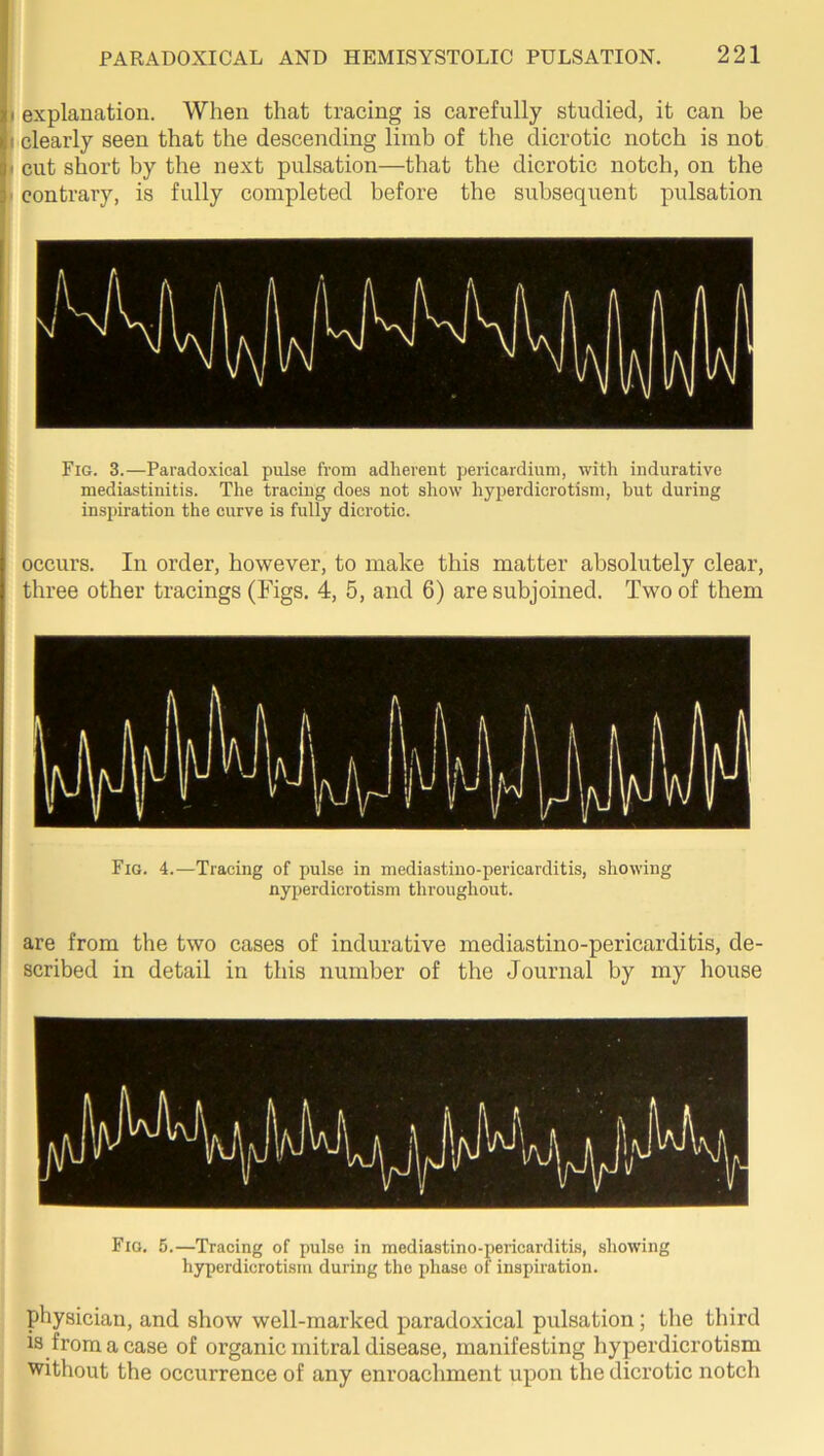 explanation. When that tracing is carefully studied, it can be clearly seen that the descending limb of the dicrotic notch is not cut short by the next pulsation—that the dicrotic notch, on the contrary, is fully completed before the subsequent pulsation Fig. 3.—Paradoxical pulse from adherent pericardium, with indurative mediastinitis. The tracing does not show hyperdicrotism, but during inspiration the curve is fully dicrotic. occurs. In order, however, to make this matter absolutely clear, three other tracings (Figs. 4, 5, and 6) are subjoined. Two of them Fig. 4.—Tracing of pulse in mediastino-pericarditis, showing Hyperdicrotism throughout. are from the two cases of indurative mediastino-pericarditis, de- scribed in detail in this number of the Journal by my house Fig. 5.—Tracing of pulse in mediastino-pericarditis, showing hyperdicrotism during the phase of inspiration. physician, and show well-marked paradoxical pulsation; the third is from a case of organic mitral disease, manifesting hyperdicrotism without the occurrence of any enroachment upon the dicrotic notch