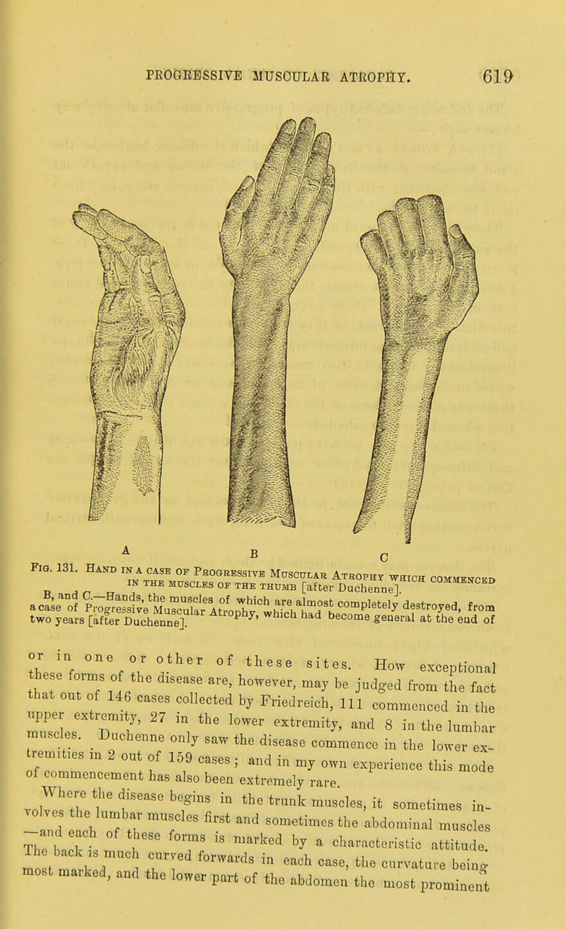 A _ ^ Fig. 131. Hand in a case of Progressive MascuLAR ATBOPHY^'waiCH commenced B ^r^ ™ ''^'^^^^ °^ ^s^ THUMB [after Duchenne] °°^™^i> two years [after Duchenne] ^^'''^ ^^'^^ general at the end of lif J^ exceptional h e Ws of the disease are, however, may be judged from the fact that out of 146 cases collected by Friedreich, 111 commenced in the muscles. _ Duchenne only saw the disease commence in the lower ex- rem,t,es m 2 out of 159 cases; and in my own experience this mode of commencement has also been extremely rare vol^T T f^^'^^^ «°-^^«mes in- The ba 1 I. m \ ^''^^'^^'^ ^ cliaructeristic attitude, most maxked, and the lower part of the abdomen the most prominent