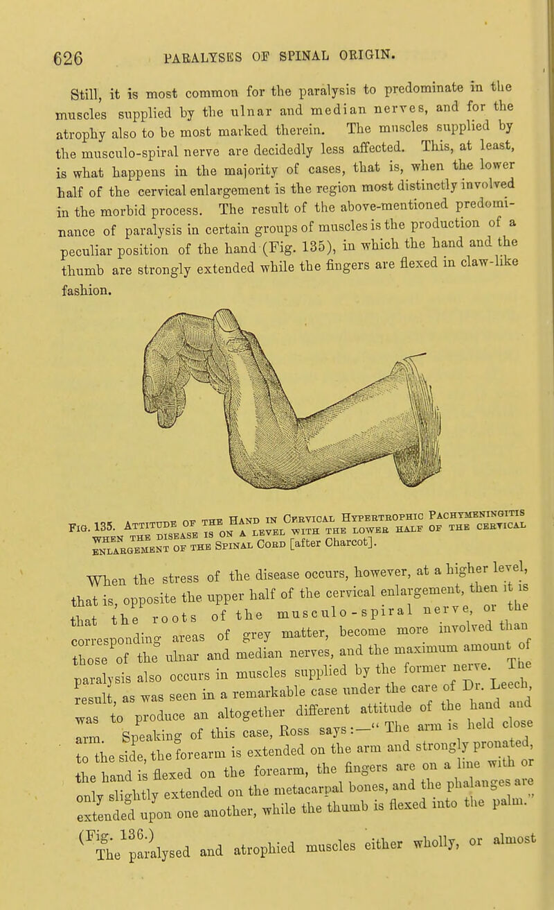 Still, it is most common for the paralysis to predominate in the muscles supplied by the ulnar and median nerves, and for the atrophy also to be most marked therein. The muscles supplied by the musculo-spiral nerve are decidedly less affected. This, at least, is what happens in the majority of cases, that is, when the lower half of the cervical enlargement is the region most distinctly involved in the morbid process. The result of the above-mentioned predomi- nance of paralysis in certain groups of muscles is the production of a peculiar position of the hand (Fig. 135), in which the hand and the thumb are strongly extended while the fingers are flexed m claw-like fashion. rLARGBMEKT OF THE SPINAL CoBD [after Charcot]. When the stress of the disease occurs, however, at a higher level, that is, opposite the upper half of the cervical enlargement, then i is that he roots of the musculo - spiral nerve, oi the c esponding areas of grey matter, become more involved than hose of th: ulnar and median nerves, and the maximum amount o pllysis also occurs in muscles supplied by the e^- J- resul as was seen in a remarkable case under the care of Di. Leech, was to produce an altogether different attitude of the hand and Z Speaking of this case, Eoss says:- The arm is held close tHhe ^de the forearm is extended on the arm and strongly pronated, 1 hand ^flexed on the forearm, the fingers are on a line with or h% ex^^^ on the metacarpal bones, and the phalanges ave extended upon one another, while the thumb is flexed into the palm. ^^Se''p!iysed and atrophied muscles either wholly, or almost