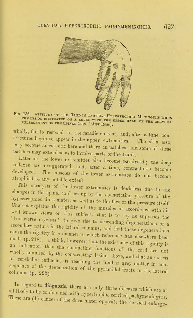 ENLAEGEMBNT OF THE SPINAL CoED falter Ross] ^^^ CEEVICAL wholly, fail to respond to the faradie current, and, after a time con- tractures begin to appear in the upper extremities. The skin' also niny become anaesthetic here and there in patches, and some of'these patches may extend so as to involve parts of the trunk. Later on, the lower extremities also become paralysed ; the deep reflexes are exaggerated, and, after a time, contractures become developed The muscles of the lower extremities do not become atrophied to any notable extent. This paralysis of the lower extremities is doubtless due to the changes m the spinal cord set up by the constricting pressure of the Ch . ot explains the rigidity of the muscles in accordance with his well known views on this subject-that is to say he suppose th transverse myelitis ' to give rise to descending degeneratlns o a Zl l nTV^^ ^'-where been Z . ! ^ , '^^^^^'^ of tWs rigidity is an ndication that the conducting functions of the cord t e n o cire^i:• ^-^-^ - -e cohZ of the pyramidal tracts in the lateral all'lil-elftoV' ^TT d---- -I-h are at ^ pachymeningitis W cancer of the dura mater opposite the cervical enlarc^e-