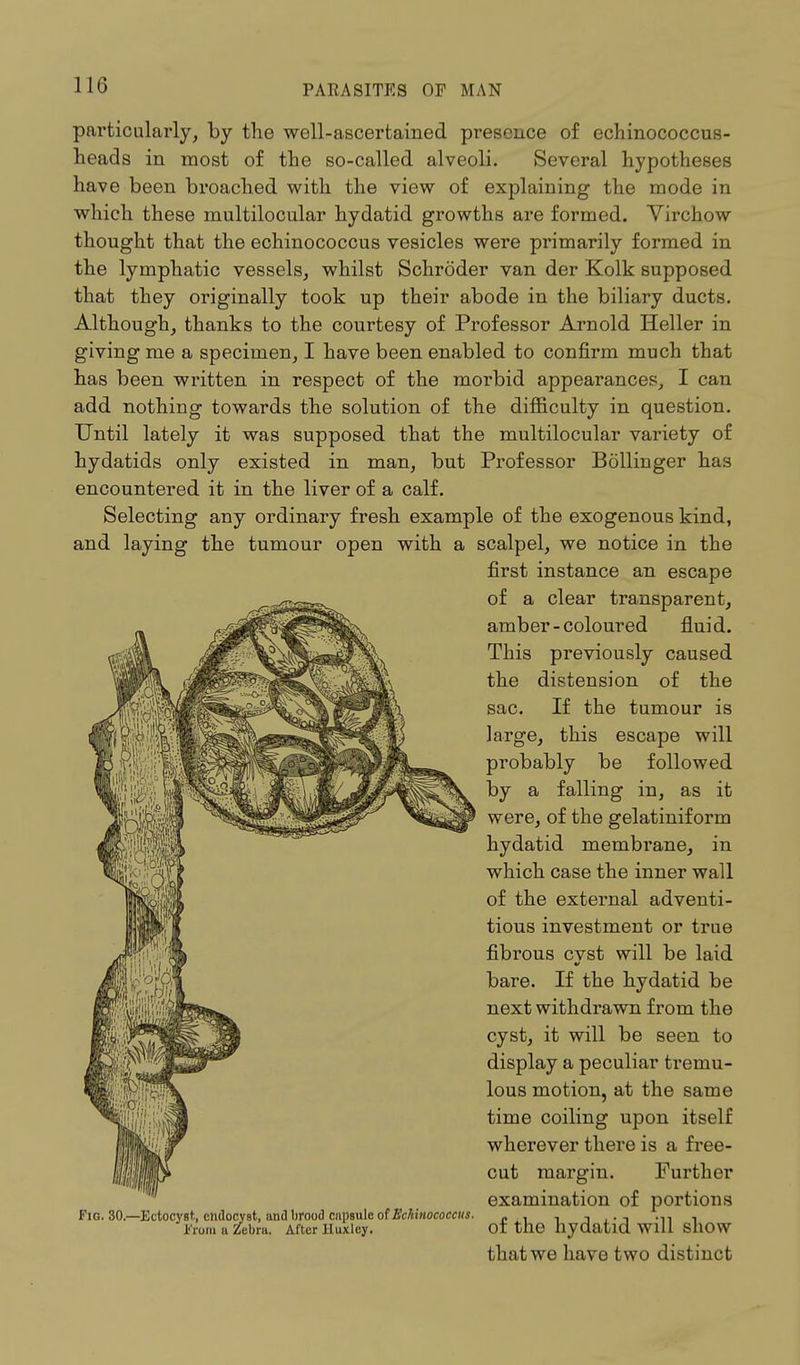 particularly, by the well-ascertained presence of echinococcus- heads in most of the so-called alveoli. Several hypotheses have been broached with the view of explaining the mode in which these multilocular hydatid growths are formed. Virchow thought that the echinococcus vesicles were primarily formed in the lymphatic vessels, whilst Schroder van der Kolk supposed that they originally took up their abode in the biliary ducts. Although, thanks to the courtesy of Professor Arnold Heller in giving me a specimen, I have been enabled to confirm much that has been written in respect of the morbid appearances, I can add nothing towards the solution of the difficulty in question. Until lately it was supposed that the multilocular variety of hydatids only existed in man, but Professor Bollinger has encountered it in the liver of a calf. Selecting any ordinary fresh example of the exogenous kind, and laying the tumour open with a scalpel, we notice in the first instance an escape of a clear transparent, amber-coloured fluid. This previously caused the distension of the sac. If the tumour is large, this escape will probably be followed by a falling in, as it were, of the gelatinif orm hydatid membrane, in which case the inner wall of the external adventi- tious investment or true fibrous cvst will be laid bare. If the hydatid be next withdrawn from the cyst, it will be seen to display a peculiar tremu- lous motion, at the same time coiling upon itself wherever there is a free- cut margin. Further examination of portions of the hydatid will show that we have two distinct Fig. 30.—Ectocyst, endocyat, and brood capsule of Echinococcus. ' From a Zebra. After Huxley.