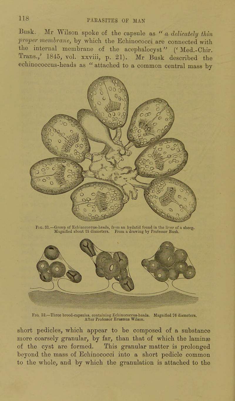 1 [° PARASITES OF MAN Busk. Mr Wilson spoke of the capsule as  a delicately thin ■proper membrane, by which the Echinococci are connected with the internal membrane of the acephalocyst (' Med.-Chir. Trans./ 1845, vol. xxviii, p. 21). Mr Busk described the echinococcus-heads as  attached to a common central mass by Fig. 31.—Group of Ecliinococcus-heads, from an hydatid found in the liver of a sheeg. Magnified about 25 diameters. From a drawing by Professor Busk. Fig. 32.—Three brood-capsules, containing Echinococcus-hends. Magnified 76 diameters. After Professor Erasmus Wilson. short pedicles, which appear to be composed of a substance more coarsely granular, by far, than that of which the laminas of the cyst are formed. This granular matter is prolonged beyond the mass of Echinococci into a short pedicle common to the whole, and by which the granulation is attached to the