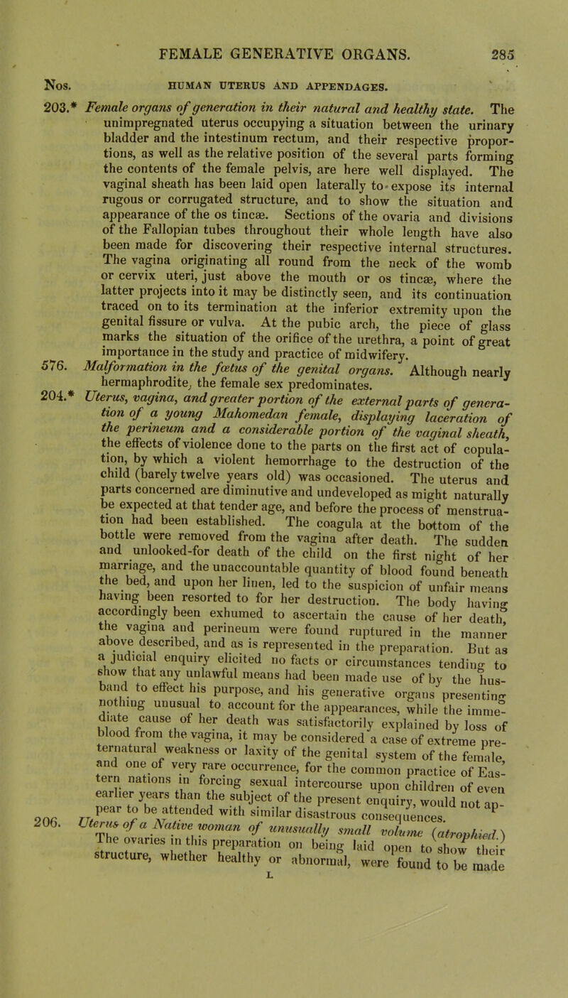 Nos. HUMAN UTERUS AND APPENDAGES. 203. * Female organs of generation in their natural and healthy state. The unirapregnated uterus occupying a situation between the urinary bladder and the intestinum rectum, and their respective propor- tions, as well as the relative position of the several parts forming the contents of the female pelvis, are here well displayed. The vaginal sheath has been laid open laterally to-expose its internal rugous or corrugated structure, and to show the situation and appearance of the os tincae. Sections of the ovaria and divisions of the Fallopian tubes throughout their whole length have also been made for discovering their respective internal structures. The vagina originating all round from the neck of the womb or cervix uteri, just above the mouth or os tincae, where the latter projects into it may be distinctly seen, and its continuation traced on to its termination at the inferior extremity upon the genital fissure or vulva. At the pubic arch, the piece of glass marks the situation of the orifice of the urethra, a point of great importance in the study and practice of midwifery. 576. Malformation in the foetus of the genital organs. Although nearly hermaphrodite^ the female sex predominates. 204. * Uterus, vagina, and greater portion of the external parts of genera- tion of a young Mahomedan female, displaying laceration of the perineum and a considerable portion of the vaginal sheath, the effects of violence done to the parts on the first act of copula- tion, by which a violent hemorrhage to the destruction of the child (barely twelve years old) was occasioned. The uterus and parts concerned are diminutive and undeveloped as might naturally be expected at that tender age, and before the process of menstrua- tion had been established. The coagula at the bottom of the bottle were removed from the vagina after death. The sudden and unlooked-for death of the child on the first night of her inarnage, and the unaccountable quantity of blood found beneath the bed and upon her linen, led to the suspicion of unfair means having been resorted to for her destruction. The body havinic accordingly been exhumed to ascertain the cause of her death the vagina and perineum were found runtiirerl in tho