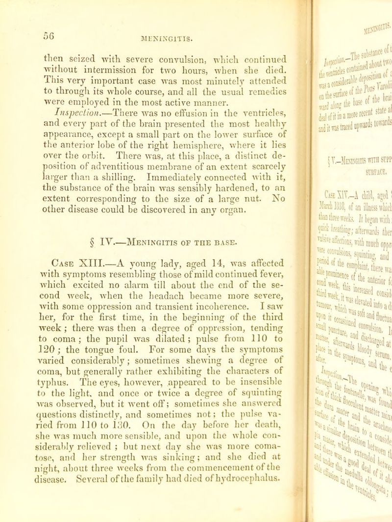 MENINGITIS. tlien seized ivitli severe convulsion, nliich continued without intermission for two hours, when she died. This very important case was most minutely attended to through its whole course, and all the usual remedies w'ere employed in the most active manner. Inspeclion.—There was no effusion in the ventricles, and every part of the brain presented the most healthy appearance, except a small part on the lower surface of the anterior lobe of the right hemisphere, where it lies over the orbit. There was, at this place, a distinct de- position of adventitious membrane of an extent scarcely larger than a shilling. Immediately connected with it, the substance of the brain was sensibly hardened, to an extent corresponding to the size of a large nut. No other disease could be discovered in any organ. § IV—Meningitis of the base. Case XIII.—A young lady, aged 14, was affected with symptoms resembling those of mild continued fever, which excited no alarm till about the end of the se- cond week, Avhen the headach became more severe, with some oppression and transient incoherence. I saw her, for the first time, in the beginning of the third week ; there was then a degree of oppression, tending to coma ; the pupil was dilated ; pulse from 110 to 120 ; the tongue foul. For some days the symptoms varied considerably; sometimes shewing a degree of coma, but generally rather exhibiting the characters of typhus. The eyes, however, appeared to be insensible to the light, and once or twice a degree of squinting w'as observed, but it ivent off; sometimes she answered questions distinctly, and sometimes not; the pulse va- ried from J 10 to FlO. On the day before her death, she was much more sensible, and upon the whole con- siderah!)^ relieved ; hut next day she was more coma- tose, and her strength was sinking; and she died at night, about three weeks from the commencement of the disease. Several of the family had died of hydrocephalus. . Tiieiuktai'W'’*'' ttevtntnw- yj yofitinamoreW™*‘'‘ d it was traced apwdstoMrds 5V,-ME.\BClTI5WlTIISrPP SniFACF., ChX1Y.-Ai •W lill8, of an tiffltireewftt!, Ii pci iireafliiQff; a affection, w, '■«e caaralsioiis. so Jfflcd of tte coDijil “*praniiaence of 'vasi .1 ^^‘*l'e.ii(iu ^Ti 5 a hf aadtl i