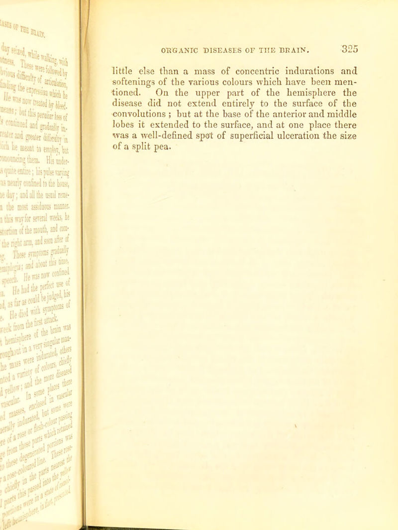 little else than a mass of concentric indurations and softenings of the yarious colours which have been men- tioned. On the upper part of the hemisphere the disease did not extend entirely to the surface of the convolutions ; but at the base of the anterior and middle lobes it extended to the surface, and at one place there was a well-defined spot of superficial ulceration the size of a split pea.