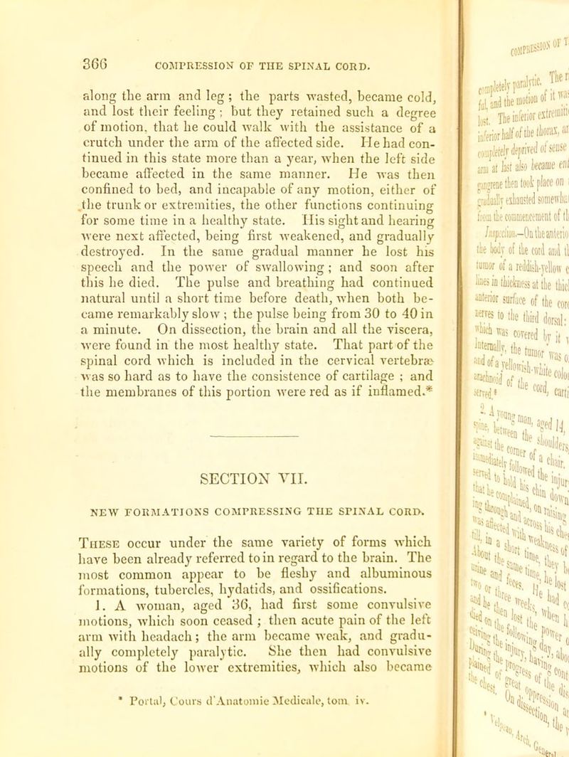 along the arm and leg ; the parts wasted, became cold, and lost their feeling ; but they retained such a degree of motion, that he could walk with the assistance of a crutch under the arm of the affected side. He had con- tinued in this state more than a year, when the left side became affected in the same manner. He was then confined to bed, and incapable of any motion, either of .the trunk or extremities, the other functions continuing for some time in a healthy state. Ilis sight and hearing were next aftected, being first weakened, and gradually destroyed. In the same gradual manner he lost his speech and the power of swallowing; and soon after this he died. The pulse and breathing had continued natural until a short time before death, when both be- came remarkably slow ; the pulse being from 30 to 40 in a minute. On dissection, the brain and all the yiscera, were found in the most healthy state. That part of the spinal cord which is included in the cervical vertebrae was so hard as to have the consistence of cartilage ; and the membranes of this portion were red as if inflamed.* SECTION YII. NEW FORMATIONS COMPRESSING THE SPINAL CORI>. These occur under the same variety of forms which have been already referred to in regard to the brain. The most common appear to be fleshy and albuminous formations, tubercles, hydatids, and ossifications. 1. A Avoman, aged 36, had first some convulsive motions, Avhich soon ceased ; then acute pain of the left arm witli headach; the arm became weak, and gradu- ally completely paralytic. She then had convulsive motions of the loiver extremities, which also became A5I0N Ot ^ fal. and the motion ]jgt, IbeinCeiioriTtreraiti' infenor ai: ofsense Mffljiieieiviiffi aril at k'l also kmtf ei)l jinpene then tool place on :-ddnaliy«han'tedsoiii fiomtheconiffieiiceraen' /wp;di(ia.-Onthe“ —jf the eo! taraor of a reddis lines in thickness; anterior surface noTfes to the tli ''Wch was core] Intemallv, the ti of the ierrf(i.« ''fiivecn (jj 111.1 •’•aUlCl ^'kcoi ’^as *111, in •ihout nrine j '^ocr ^dhe * Portal, Coins d'.'Vnatoniie Medicale, tom iv.