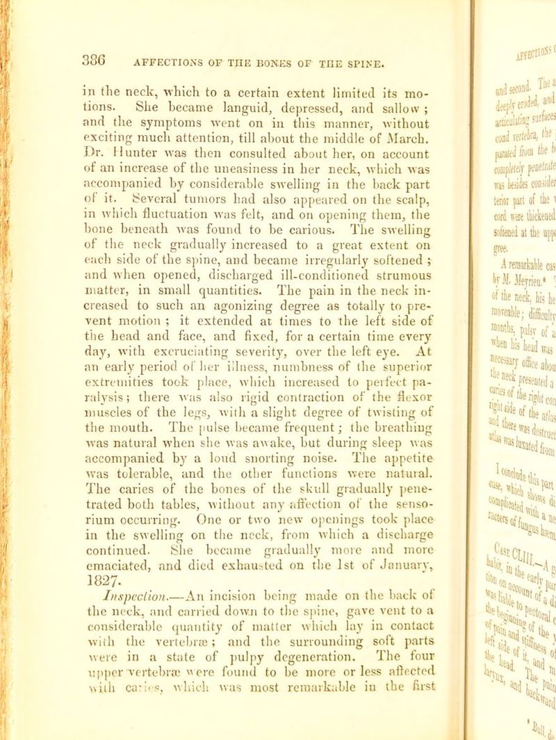 in the neck, which to a certain extent limited its mo- tions. She became languid, depressed, and sallow ; and the symptoms went on in this manner, Avithout exciting much attention, till about the middle of March. Dr. II unter was then consulted about her, on account of an increase of the uneasiness in her neck, which Avas accompanied by considerable SAvelling in the hack part ot it. ScA’cral tumors had also appeared on the scalp, in AA’hich fluctuation aa'os felt, and on opening them, the hone beneath Avas found to he carious. The SAvelling of the neck gradually increased to a great extent on each side of the spine, and became irregularly softened ; and AA'hen opened, discharged ill-conditioned strumous matter, in small quantities. The pain in the neck in- creased to such an agonizing degree as totally to pre- vent motion ; it extended at times to the left side of the head and face, and fixed, for a certain time every day, Avith excruciating severity, over the left eye. At an early period of her illness, numbness of the superior extremities took place, which increased to perfect pa- ralysis; there Avas also rigid contraction of the flexor muscles of the legs, Avith a slight degree of twisting of the mouth. The pulse became frequent; the breathing Avas natural when she Avas arvake, hut during sleep Avas accompanied by a loud snorting noise. The appetite Avas tolerable, and the other functions Avere natural. The caries of the hones of the skull gradually pene- trated both tables, Avithout any aftection of the .senso- rium occurring. One or two neAv openings took place in the SAvelling on the neck, from Avhich a discharge continued. ^he became gradually more and more emaciated, and died exhausted on the 1st of January, 1827. 1/ixpeclion.—An incision being made on the hack ot the neck, and carried doAvn to the spine, gave vent to a considerable (piantity of matter Avhich lay in contact Aviih the vertebrae; and the surrounding soft parts Avere in a state of J'ulpy degeneration. The four upper vertebra'  cre found to be more or le.ss aftected A\ith caries, Avhich was most remarkable in the first