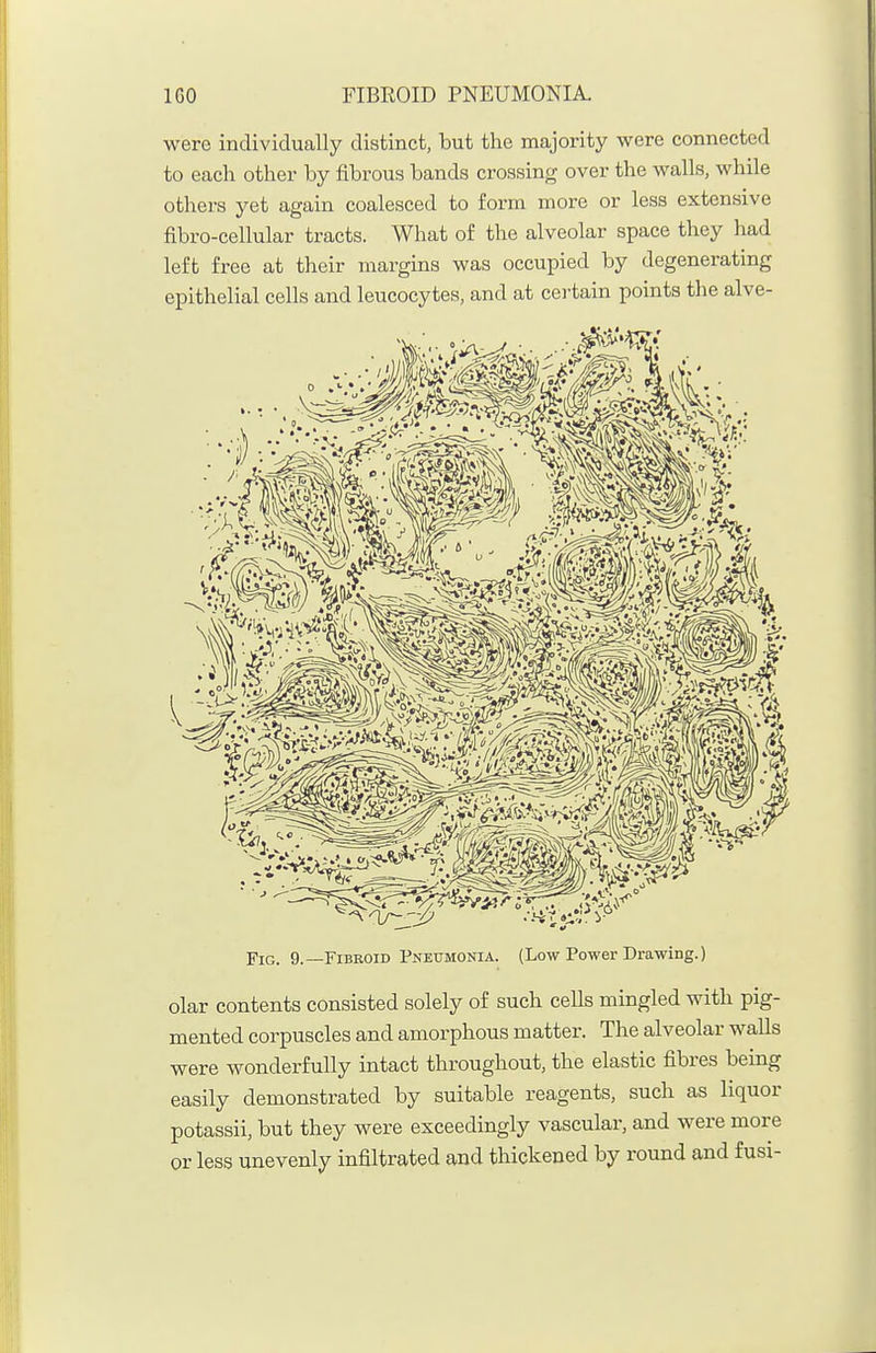 were individually distinct, but the majority were connected to each other by fibrous bands crossing over the walls, while others yet again coalesced to form more or less extensive flbro-cellular tracts. What of the alveolar space they had left free at their margins was occupied by degenerating epithelial cells and leucocytes, and at certain points the alve- FiG. 9.—Fibroid Pneumonia. (Low Power Drawing.) olar contents consisted solely of such cells mingled with pig- mented corpuscles and amorphous matter. The alveolar walls were wonderfully intact throughout, the elastic fibres being easily demonstrated by suitable reagents, such as liquor potassii, but they were exceedingly vascular, and were more or less unevenly infiltrated and thickened by round and fusi-