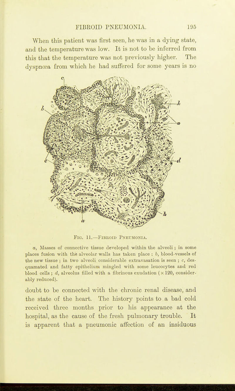 When this patient was first seen, he was in a dying state, and the temperature was low. It is not to be inferred from this that the temperature was not previously higher. The dyspnoea from which he had suffered for some years is no Fig. 11.—Fibroid Pneumonia. o, Masses of connective tissue developed within the alveoli; in some places fusion with the alveolar walls has taken place ; &, blood-vessels of the new tissue ; in two alveoli considerable exti'avasation is seen ; c, des- quamated and fatty epitlielium mingled with some leucocytes and red blood cells ; d, alveolus filled witli a fibrinous exudation ( x 120, consider- ably reduced). doubt to be connected with the chronic renal disease, and the state of the heart. The history points to a bad cold received three months prior to his appearance at the hospital, as the cause of the fresh pulmonary trouble. It is apparent that a pneumonic affection of an insiduous