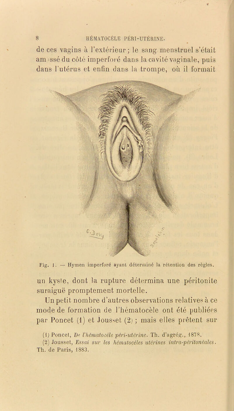 de ces vagins à l’extérieur; le sang menstruel s’était am issé du côté imperforé dans la cavité vaginale, puis dans l’utérus et enfin dans la trompe, où il formait Fig. 1. — Hymen imperforé ayant déterminé la rétention des règles. un kyste, dont la rupture détermina une péritonite suraiguë promptement mortelle. Un petit nombre d’autres observations relatives à ce mode de formation de l’hématocèle ont été publiées par Poncet (1) et Jousset (2) ; mais elles prêtent sur (1) Poncet, Dr Vhématoeèle péri-utérine- Th. d’agrég., 1878. (2) Jousset, Essai sur les hémutocèles utérines intra-péritonéales. Th. de Paris, 1883.