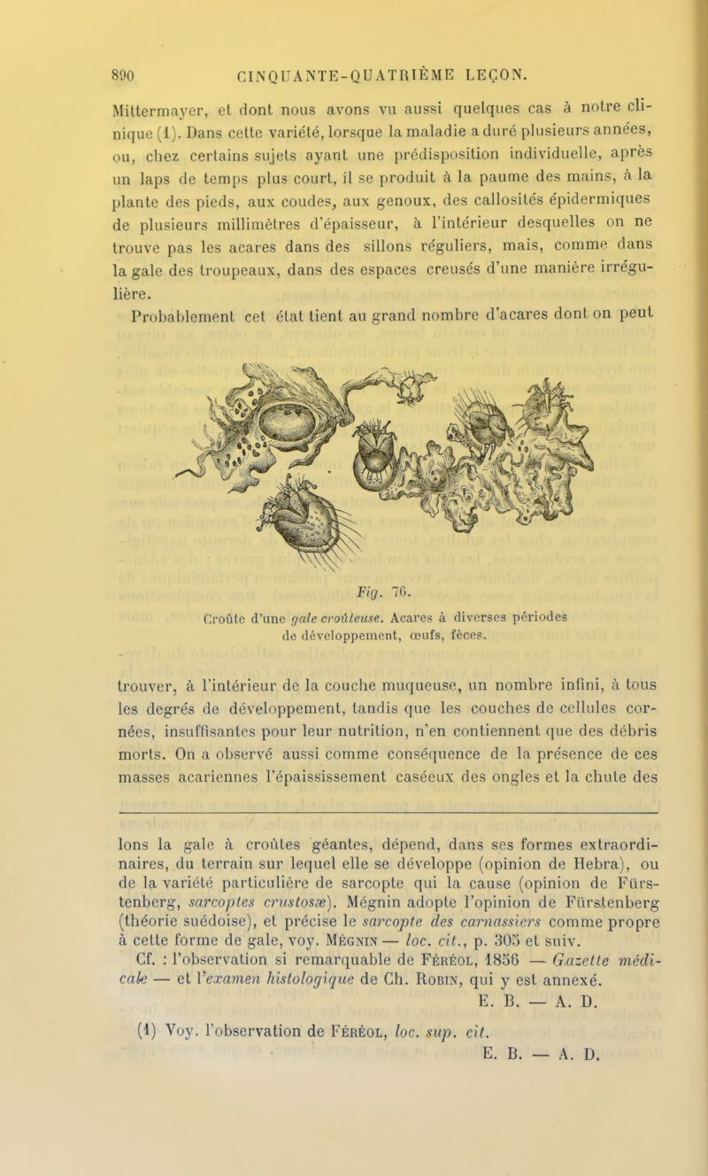 Miltermayer, et dont nous avons vu aussi quelques cas à notre cli- nique (1). Dans cette variété, lorsque la maladie a duré plusieurs années, ou, chez certains sujets ayant une prédisposition individuelle, après un laps de temps plus court, il se produit à la paume des mains, à la plante des pieds, aux coudes, aux genoux, des callosités épidermiques de plusieurs millimètres d'épaisseur, à l'intérieur desquelles on ne trouve pas les acares dans des sillons réguliers, mais, comme dans la gale des troupeaux, dans des espaces creusés d'une manière irrégu- lière. Probablement cet état tient au grand nombre d'acares dont on peut Fig. 70. Croûte d'une r/ale croiUeuse. Acares à diverses périodes de développement, œufs, fèces. trouver, à l'intérieur de la couche muqueuse, un nombre infini, à tous les degrés de développement, tandis que les couches de cellules cor- nées, insuffisantes pour leur nutrition, n'en contiennent que des débris morts. On a observé aussi comme conséquence de la présence de ces masses acariennes l'épaississement caséeux des ongles et la chute des Ions la gale à croûtes géantes, dépend, dans ses formes extraordi- naires, du terrain sur lequel elle se développe (opinion de Hebra), ou de la variété particulière de sarcopte qui la cause (opinion de Furs- tenberg, sarcoptes crustosœ). Mégnin adopte l'opinion de Furslenberg (théorie suédoise), et précise le sarcopte des carnassiers comme propre à cette forme de gale, voy. Mégnin— loc. cit., p. 305 et sniv. Cf. : l'observation si remarquable de Féréol, 1856 — Gazette médi- cale — et Vexamen histologique de Ch. Robin, qui y est annexé. E. B. — A. D. (1) Voy. l'observation de Féréol, loc. sup. cit. E. B. — A. D.