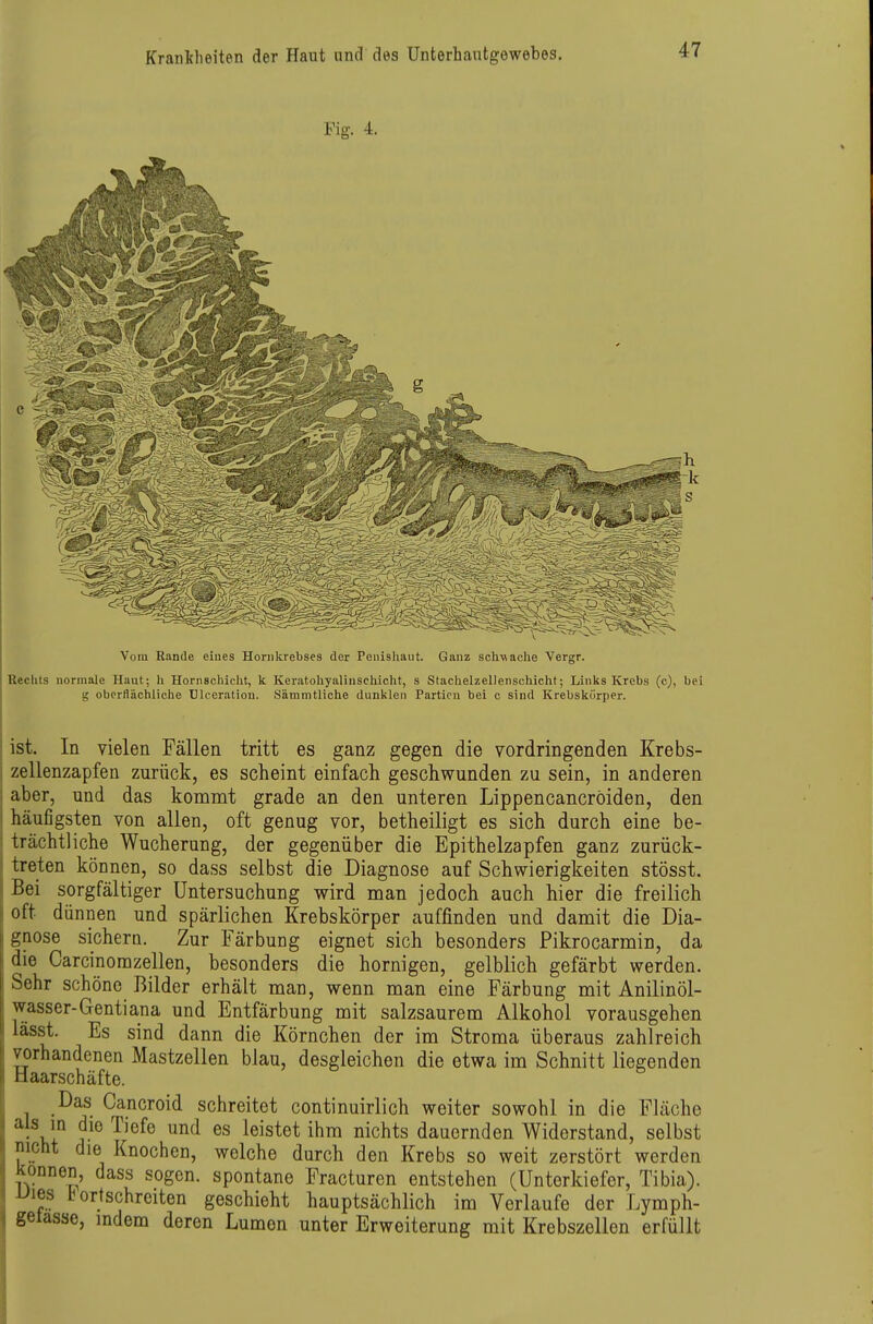 Fig. 4. Vom Rande eiues Horiikrebses der Penishaut. Ganz schN\ache Vergr. Rechts normale Haut; h Hornschiclit, k Keratohyalinschicht, s Stachelzellenschicht; Links Krebs (c), bei g oberflächliche Dlceration. Sämnitliche dunklen Partien bei c sind Krebskürper. ist. In vielen Fällen tritt es ganz gegen die vordringenden Krebs- zellenzapfen zurück, es scheint einfach geschwunden zu sein, in anderen i aber, und das kommt grade an den unteren Lippencancröiden, den 1 häufigsten von allen, oft genug vor, betheiligt es sich durch eine be- 1 trächtliche Wucherung, der gegenüber die Epithelzapfen ganz zurück- :] treten können, so dass selbst die Diagnose auf Schwierigkeiten stösst. ) Bei sorgfältiger Untersuchung wird man jedoch auch hier die freilich oft dünnen und spärlichen Krebskörper auffinden und damit die Dia- gnose sichera. Zur Färbung eignet sich besonders Pikrocarmin, da die Carcinomzellen, besonders die hornigen, gelblich gefärbt werden. Sehr schöne Bilder erhält man, wenn man eine Färbung mit Anilinöl- wasser-Gentiana und Entfärbung mit salzsaurem Alkohol vorausgehen lässt. Es sind dann die Körnchen der im Stroma überaus zahlreich vorhandenen Mastzellen blau, desgleichen die etwa im Schnitt liegenden naarschäfte. Das Cancroid schreitet continuirlich weiter sowohl in die Fläche i als in die Tiefe und es leistet ihm nichts dauernden Widerstand, selbst I] nicht die Knochen, welche durch den Krebs so weit zerstört werden können, dass sogen, spontane Fracturen entstehen (Unterkiefer, Tibia). iJies b ortschreiten geschieht hauptsächlich im Verlaufe der Lymph- gelasse, indem deren Lumen unter Erweiterung mit Krebszellen erfüllt I