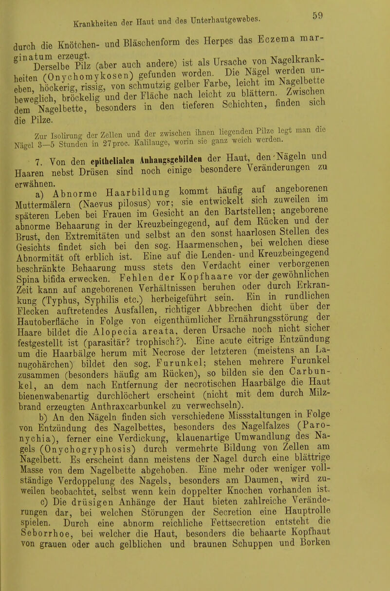 durch die Knötchen- und Bläschenform des Herpes das Eczema mar- ^''CseCpt (aber auch andere) ist als Ursache von Nagelkrank- h„iterrOnvchomvkosen) gefunden worden. Die Nägel wfden un- i hiSkerig nsl von schmutzig gelber Farbe, leicht im Nagelbette fewe'sS b öckeligmd der Fläche nach leicht zu blättern. Zwischen Nagelbette, besonders in den tieferen Schichten, finden svch die Pilze. Zm- Isolii-ung der Zellen und der zwischen ihnen liegenden Pilze legt man die Nägel 3-5 Skmden in 27proc. Kalilauge, woiin sie ganz weich werden. 7 Von den epithelialen Aohaugsgebilden der Haut den'Nägeln und Haaren nebst Drüsen sind noch einige besondere Veränderungen zu ''^ar^bnorme Haarbildung kommt häufig auf angeborenen Muttermälern (Naevus pilosus) vor; sie entwickelt sich zuweilen im späteren Leben bei Fragen im Gesicht an den Bartstellen; angeborene abnorme Behaarung in der Kreuzbeingegend, auf dem Rucken und der Brust, den Extremitäten und selbst an den sonst haarlosen Steilen des Gesichts findet sich bei den sog. Haarmenschen, bei welchen diese Abnormität oft erblich ist. Eine auf die Lenden- und Kreuzbeingegend beschränkte Behaarung muss stets den Verdacht einer verborgenen Spina bifida erwecken. Fehlen der Kopfhaare vor der gewöhnlichen Zeit kann auf angeborenen Verhältnissen beruhen oder durch l^^Kran- kung (Typhus, Syphilis etc.) herbeigeführt sein. Em m rundlichen Flecken auftretendes Ausfallen, richtiger Abbrechen dicht über der Hautoberfläche in Folge von eigenthümlicher Ernährungsstörung der Haare bildet die Alopecia areata, deren Ursache noch nich. sicher festgestellt ist (parasitär? trophisch?). Eine acute eitrige Entzündung um die Haarbälge herum mit Necrose der letzteren (meistens an La- nugohärchen) bildet den sog. Furunkel; stehen mehrere Furunkel zusammen (besonders häufig am Rücken), so bilden sie den Karbun- kel, an dem nach Entfernung der necrotischen Haarbälge die Haut bienenwabenartig durchlöchert erscheint (nicht mit dem durch Milz- brand erzeugten Anthraxcarbunkel zu verwechseln). b) An den Nägeln finden sich verschiedene Missstaltungen in Folge von Entzündung des Nagelbettes, besonders des Nagelfalzes (Paro- nychia), ferner eine Verdickung, klauenartige Umwandlung des Na- gels (Onychogryphosis) durch vermehrte Bildung von Zellen am Nagelbett. Es erscheint dann meistens der Nagel durch eine blättrige Masse von dem Nagelbette abgehoben. Eine mehr oder weniger voll- ständige Verdoppelung des Nagels, besonders am Daumen, wird zu- weilen beobachtet, selbst wenn kein doppelter Knochen vorhanden ist. c) Die drüsigen Anhänge der Haut bieten zahlreiche Verände- rungen dar, bei welchen Störungen der Secretion eine Hauptrolle spielen. Durch eine abnorm reichliche Fettsecretion entsteht die Seborrhoe, bei welcher die Haut, besonders die behaarte Kopfhaut von grauen oder auch gelblichen und braunen Schuppen und Borken
