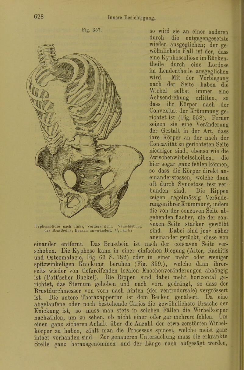 so wird sie an einer anderen durch die entgegengesetzte wieder ausgeglichen; der ge- wöhnlichste Fall ist der, dass eine Kyphoscoliose im Rücken- theile durch eine Lordose im Lendentheile ausgeglichen wird. Mit der Verbiegung nach der Seite haben die Wirbel selbst immer eine Achsendrehung erlitten, so dass ihr Körper nach der Convexität der Krümmung ge- richtet ist (Fig. 358). Ferner zeigen sie eine Veränderung der Gestalt in der Art, dass ihre Körper an der nach der Concavität zu gerichteten Seite niedriger sind, ebenso wie die Zwischenwirbelscheiben, die hier sogar ganz fehlen können, so dass die Körper direkt an- einanderstossen, welche dann oft durch Synostose fest ver- bunden sind. Die Rippen zeigen regelmässig Verände- rungen ihrer Krümmung, indem die von der concaven Seite ab- gehenden flacher, die der con- Kyphoscoliose nach links, Vorderansicht. Verschiebung VCXCn Seito ^ Stärkor geWÖlbt des Brustbeins; Becken unverändert. '/lUat. Gr. sind. Dabci Sind jeDfi näher aneinander gerückt, diese von einander entfernt. Das Brustbein ist nach der concaven Seite ver- schoben. Die Kyphose kann in einer einfachen Biegung (Alter, Rachitis und Osteomalacie, Fig. 63 S. 182) oder in einer mehr oder weniger spitzwinkeligen Knickung beruhen (Fig. 359.), welche dann ihrer- seits wieder von tiefgreifenden loöalen Knochenveränderungen abhängig ist (Pott'scher Buckel). Die Rippen sind dabei mehr horizontal ge- richtet, das Sternum gehoben und nach vorn gedrängt, so dass der Brustdurchmesser von vorn nach hinten (der ventrodorsale) vergrössert ist. Die untere Thoraxappertur ist dem Becken genähert. Da eine abgelaufene oder noch bestehende Caries die gewöhnlichste Ursache der Knickung ist, so muss man stets in solchen Fällen die Wirbelkörper nachzählen, um zu sehen, ob nicht einer oder gar mehrere fehlen. Um einen ganz sicheren Anhalt über die Anzahl der etwa zerstörten Wirbel- körper zu haben, zälilt man die Processus spinosi, welche meist ganz intact vorhanden sind. Zur genaueren Untersuchung muss die erkrankte Stelle ganz herausgenommen und der Länge nach aufgesägt werden. Fig. 357.