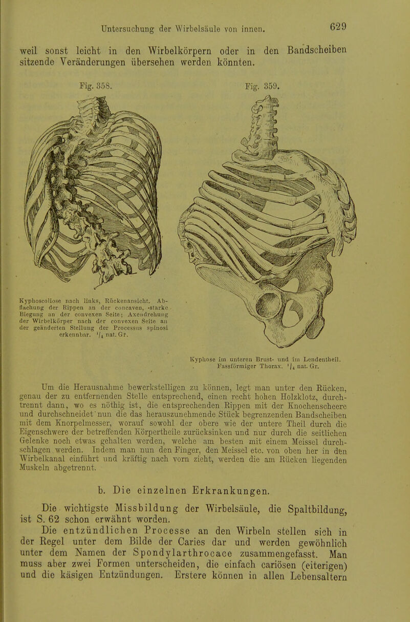 weil sonst leicht in den Wirbelkörpern oder in den Bandscheiben sitzende Veränderungen übersehen werden könnten. Fig. 358. Fig. 359. ICypIiose im unteren Brust- und im Leiidentheil. Passförmiger Thorax, 'j^nat. Gr. Um die Herausnalime bewerkstelligen zu können, legt man unter den Eücken, genau der zu entfernenden Stelle entsprechend, einen recht hohen Holzklotz, dm-ch- trennt dann, wo es nöthig ist, die entsprechenden Rii^pen mit der Knochenscheere und durchschneidet ■ nun die das herauszunehmende Stück begrenzenden Bandscheiben mit dem Knorpelmesser, worauf sowohl der obere wie der untere Theil durch die Eigenschwere der betreffenden Körpertheile zurücksinken und nur durch die seitlichen Gelenke noch etwas gehalten werden, welche am besten mit einem Meissel durch- schlagen werden. Indem mau nun den Finger, den Meissel etc. von oben her in den Wirbelkanal einführt und kräftig nach vorn zieht, werden die am Rücken liegenden Muskeln abgetrennt. b. Die einzelnen Erkrankungen. Die wichtigste Missbildung der Wirbelsäule, die Spaltbildung, ist S, 62 schon erwähnt worden. Die entzündlichen Processe an den Wirbeln stellen sich in der Regel unter dem Bilde der Caries dar und werden gewöhnlich unter dem Namen der Spondylarthrocace zusammengefasst. Man muss aber zwei Formen unterscheiden, die einfach cariösen (eiterigen) und die käsigen Entzündungen. Erstere können in allen Lebensaltern