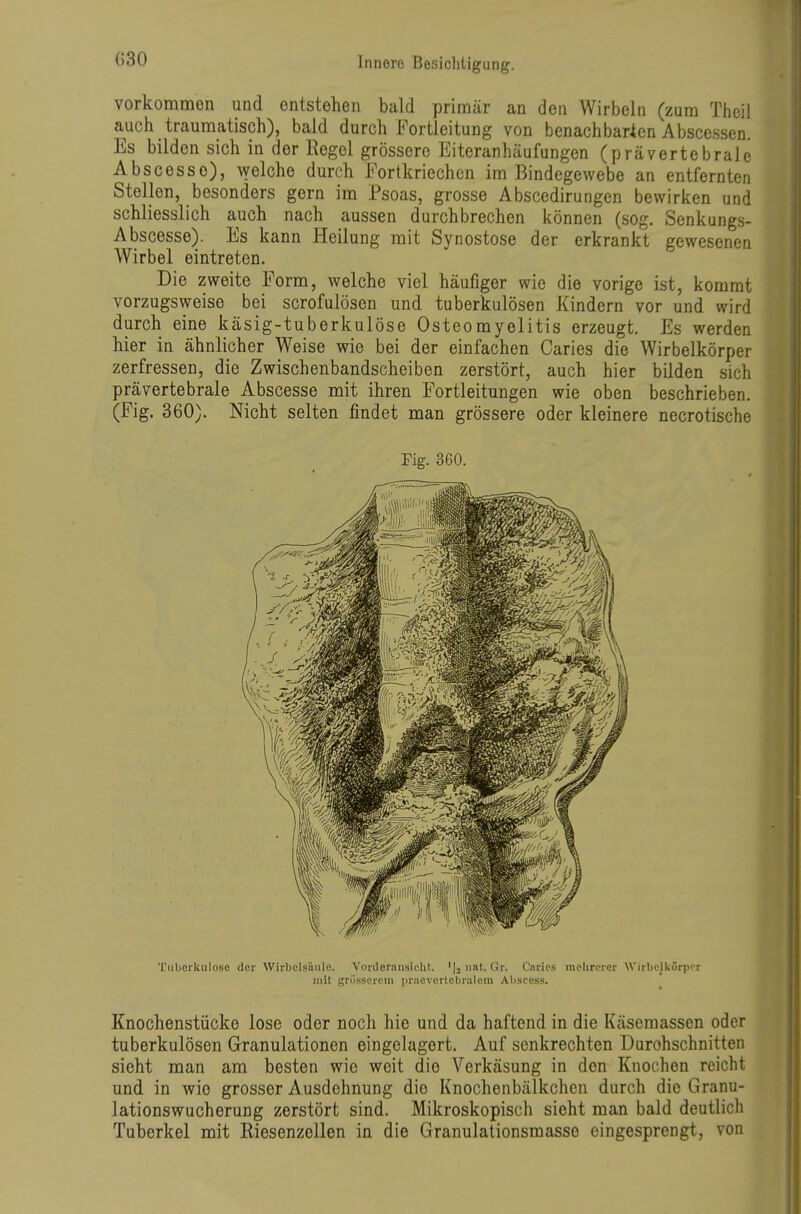 vorkommen und entstehen bald primär an den Wirbeln (zum Theil auch traumatisch), bald durch Portleitung von benachbarien Abscessen. Es bilden sich in der Regel grössere Eiteranhäufungen (prävertebrale Abscesso), welche durch Portkriechen im Bindegewebe an entfernten Stellen, besonders gern im Psoas, grosse Abscedirungen bewirken und schliesslich auch nach aussen durchbrechen können (sog. Senkungs- Abscesse). Es kann Heilung mit Synostose der erkrankt gewesenen Wirbel eintreten. Die zweite Porm, welche viel häufiger wie die vorige ist, kommt vorzugsweise bei scrofulösen und tuberkulösen Kindern vor und wird durch eine käsig-tuberkulöse Osteomyelitis erzeugt. Es werden hier in ähnlicher Weise wie bei der einfachen Caries die Wirbelkörper zerfressen, die Zwischenbandscheiben zerstört, auch hier bilden sich prävertebrale Abscesse mit ihren Portleitungen wie oben beschrieben. (Pig. 360). Nicht selten findet man grössere oder kleinere necrotische Fig. 360. Tuberkulose der Wirbelsäule. Vorderansicht. 'Ijunt. Gr. Caries inelirerer WirbclkSrpor mit grösscreui praevertcbralem Abscess. Knochenstücke lose oder noch hie und da haftend in die Käsemassen oder tuberkulösen Granulationen eingelagert. Auf senkrechten Durchschnitten sieht man am besten wie weit die Verkäsung in den Knochen reicht und in wie grosser Ausdehnung die Knochenbälkchen durch die Granu- lationswucherung zerstört sind. Mikroskopisch sieht man bald deutlich Tuberkel mit Riesenzellen in die Granulationsmasse eingesprengt, von