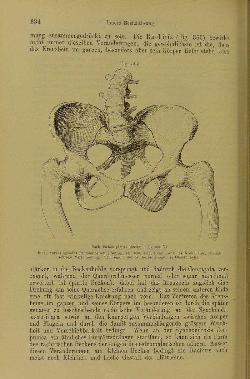 mung zusammengedrückt zu sein. Die Rachitis (Fig. 365) bewirkt nicht immer dieselben Veränderungen; die gewöhnlichste ist die, d;is.s das Kreuzbein im ganzen, besonders aber sein Körper tiefer steht, also Fig. 365. Rachitisches plattes Becken. nat. Gr. Stark vorspringendes Proraontorinm (Conjug. ver.-fi^OO cm), ICrinnrauiig des Kreuzbeins, geringe schräge Verscliiebmig. Verbiegiing der Wirbelsäule und der Oberschenkel. stärker in die Beckenhöhle vorspringt und dadurch die Conjugata ver- engert, während der Querdurchmesser normal oder sogar manchmal erweitert ist (platte Becken), dabei hat das Kreuzbein zugleich eine Drehung um seine Querachse erfahren und zeigt an seinem unteren Ende eine oft fast winkelige Knickung nach vorn. Das Vortreten des Kreuz- beins im ganzen und seines Körpers im besonderen ist durch die später genauer zu beschreibende rachitische Veränderung an der Synchondr. sacro iliaca sowie an den knorpeligen Verbindungen zwischen Körper und Flügeln und durch die damit zusammenhängende grössere Weich- heit und Verschiebbarkeit bedingt. Wenn an der Synchondrosis ilco- pubica ein ähnliches Einwärtsdrängen stattfand, so kann sich die Form des rachitischen Beckens derjenigen des osteomalacischen nähern. Ausser diesen Veränderungen am kleinen Becken bedingt die Rachitis auch meist noch Kleinheit und (lache Gestalt der Hüftbeine.