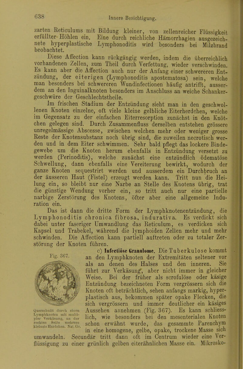 G38 zarten Reticulums mit Bildung kleiner, von zellenreicher Flüssigkeit erfüllter Höhlen ein. Eine durch reichliche Hämorrhagien ausgezeich- nete hyperplastische Lynophonoditis wird besonders bei Milzbrand beobachtet. Diese Aifection kann rückgängig werden, indem die überreichlich vorhandenen Zellen, zum Theil durch Verfettung, wieder verschwinden. Es kann aber die Affection auch nur der Anfang einer schwereren Ent- zündung, der eiterigen (Lymphonoditis apostematosa) sein, welche man besonders bei schwereren Wundinfectionen häufig antrifft, ausser- dem an den Tnguinalknoten besonders im Anschluss an weiche Schanker- geschwüre der Geschlechtstheile. Im frischen Stadium der Entzündung sieht man in den geschwol- lenen Knoten einzelne, oft viele kleine gelbliche Eiterherdchen, welche im Gegensatz zu der einfachen Eiterresorption zunächst in den Knöt- chen gelegen sind. Durch Zusammenfluss derselben entstehen grössere unregelmässige Abscesse, zwischen welchen mehr oder weniger grosse Reste der Knotensubstanz noch übrig sind, die zuweilen necrotisch wer- den und in dem Eiter schwimmen. Sehr bald pflegt das lockere Binde- gewebe um die Knoten herum ebenfalls in Entzündung versetzt zu werden (Perinoditis), welche zunächst eine entzündlich ödematöse Schwellung, dann ebenfalls eine Vereiterung bewirkt, wodurch der ganze Knoten sequestrirt werden und ausserdem ein Durchbruch an der äusseren Haut (Fistel) erzeugt werden kann. Tritt nun die Hei- lung ein, so bleibt nur eine Narbe an Stelle des Knotens übrig, trat die günstige Wendung vorher ein, so tritt auch nur eine partielle narbige Zerstörung des Knotens, öfter aber eine allgemeine Indu- ration ein. Das ist dann die dritte Form der Lymphknotenentzündung, die Lymphonoditis chronica fibrosa, indurativa. Es verdickt sich dabei unter faseriger Umwandlung das Reticulum, es verdicken sich Kapsel und Trabekel, während die lymphoiden Zellen mehr und mehr schwinden. Die Affection kann partiell auftreten oder zu totaler Zer- störung der Knoten führen. c) Iiifcctiöse Granulome. Die Tuberkulose kommt an den Lymphknoten der Extremitäten seltener vor als an denen des Halses und den inneren. Sie führt zur Verkäsung, aber nicht immer in gleicher Weise. Bei der früher als scrofulöse oder käsige Entzündung bezeichneten Form vergrössern sich die Knoten oft beträchtlich, sehen anfangs markig, hyper- plastisch aus, bekommen später opake Flecken, die sich vergrössern und immer deutlicher ein käsiges Aussehen annehmen (Fig. 367). Es kann schliess- lich, wie besonders bei den mesenterialen Knoten schon erwähnt wurde, das gesammte Parenchym in eine homogene, gelbe, opake, trockene Masse sich umwandeln. Secundär tritt dann oft im Centrum wieder eine Ver- flüssigung zu einer grünlich gelben eiterähnlichon Masse ein. Mikrosko- Fig. 367. Querschnitt diirrh einen Tjjmplilcnotcn mit nuiUi- pler Verkäsuni;, an der recliten Seite inelirero Kleinste Herdclien. Nat.Gr