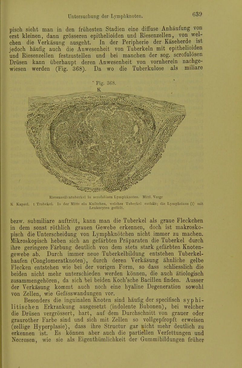 pisch sieht man in den frühesten Stadien eine diffuse Anhäufung von erst kleinen, dann grösseren epithelioiden und Riesenzellen, von wel- chen die Verkäsung ausgeht. In der Peripherie der Käseherde ist jedoch häufig auch die Anwesenheit von Tuberkeln mit epithelioiden und Riesenzellen festzustellen und bei manchen der sog. scrofulösen Drüsen kann überhaupt deren Anwesenheit von vornherein nachge- wiesen werden (Fig. 368). Da wo die Tuberkulose als miliare ' Fig. 3G8. Rieseuzellcntuberkel in scrofulösen Lymphknoten. Mittl. Vergr K Kapsel, t Trabekel. In der Mltto ein Knötchen, welches Tuberkel enthält; die Lymphsiuus (1) mit Leukocyten gefüllt. bezw. submiliare auftritt, kann man die Tuberkel als graue Fleckchen in dem sonst röthlich grauen Gewebe erkennen, doch ist makrosko- pisch die Unterscheidung von Lymphknötchen nicht immer zu machen. Mikroskopisch heben sich an gefärbten Präparaten die Tuberkel durch ihre geringere Färbung deutlich von dem stets stark gefärbten Knoten- gewebe ab. Durch immer neue Tuberkelbildung entstehen Tuberkel- haufen (Conglomeratknoten), durch deren Verkäsung ähnliche gelbe Flecken entstehen wie bei der vorigen Form, so dass schliesslich die beiden nicht mehr unterschieden werden können, die auch ätiologisch zusammengehören, da sich bei beiden Koch'sche Bacillen finden. Ausser der Verkäsung kommt auch noch eine hyaline Degeneration sowohl von Zellen, wie Gefässwandungen vor. Besonders die inguinalen Knoten sind häufig der specifisch syphi- litischen Erkrankung ausgesetzt (indolente Bubonen), bei welcher die Drüsen vergrössert, hart, auf dem Durchschnitt von grauer oder graurother Farbe sind und sich mit Zellen so vollgepfropft erweisen (zellige Hyperplasie), dass ihre Structur gar nicht mehr deutlich zu erkennen ist. Es können aber auch die partiellen Verfettungen und Nccrosen, wie sie als Eigenthümlichkeit der Gummibildungen früher