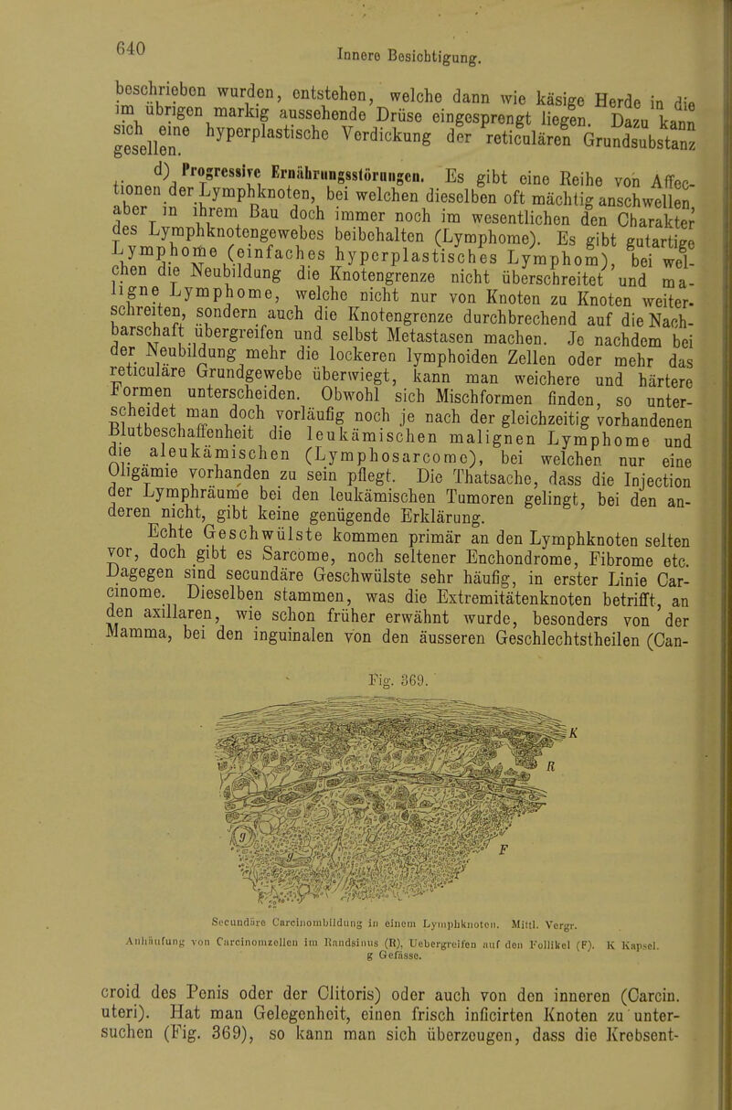 beschrieben wurden, onts;tehen, welche dann wie käsige Herde in die im übrigen markig aussehende Drüse eingesprengt liegen. Da.u kann geseller '^P^^P^^^*'««^^ ^-^-^ung dir 'reticulären Grund'ubstanz +,•..^^^^'''^1 '^'i;'i»»r»g8s<ör«Scn. Es gibt eine Reihe von Affec- tionen der Lymphknoten, bei welchen dieselben oft mächtig anschwel aber in ihrem Bau doch immer noch im wesentlichen derCharak des Lymphknotengewebes beibehalten (Lymphome). Es gibt gutartige hypcrplastisches Lymphom), ^ we? chen die Neubildung die Knotengrenze nicht überschreitet und ma- ligne Lymphome, welche nicht nur von Knoten zu Knoten weiter- schreiten sondern auch die Knotengrenze durchbrechend auf die Nach- barschaft ubergreifen und selbst Metastasen machen. Je nachdem bei der Neubildung mehr die lockeren lymphoiden Zellen oder mehr das reticulare Grundgewebe überwiegt, kann man weichere und härtere i^ormen unterscheiden. Obwohl sich Mischformen finden, so unter- i^'^.f J^ofh vorläufig noch je nach der gleichzeitig vorhandenen ßlutbeschaffenheit die leukämischen malignen Lymphome und die aleukämischen (Lymphosarcome), bei welchen nur eine Oligämie vorhanden zu sein pflegt. Die Thatsache, dass die Injection der Lymphraume bei den leukämischen Tumoren gelingt, bei den an- deren nicht, gibt keine genügende Erklärung. Echte Geschwülste kommen primär an den Lymphknoten selten vor, doch gibt es Sarcome, noch seltener Enchondrome, Fibrome etc Dagegen sind secundäre Geschwülste sehr häufig, in erster Linie Car- cinome. Dieselben stammen, was die Extremitätenknoten betrifft, an den axillaren, wie schon früher erwähnt wurde, besonders von der Mamma, bei den inguinalen von den äusseren Geschlechtstheilen (Can- Pig. 369. Aiiliiiiifunj Secundäre Carciiiombildung in einem Lyinpliknoteii. Miltl. Vcrgr. von Ciircinonizelleu im Randsinus (R), Uebergreifen «uf den Follikel (F). K Kapsel. g Gefässo. croid des Penis oder der Clitoris) oder auch von den inneren (Carcin. uteri). Hat man Gelegenheit, einen frisch inficirten Knoten zu unter- suchen (Fig. 369), so kann man sich überzeugen, dass die Krebsent-