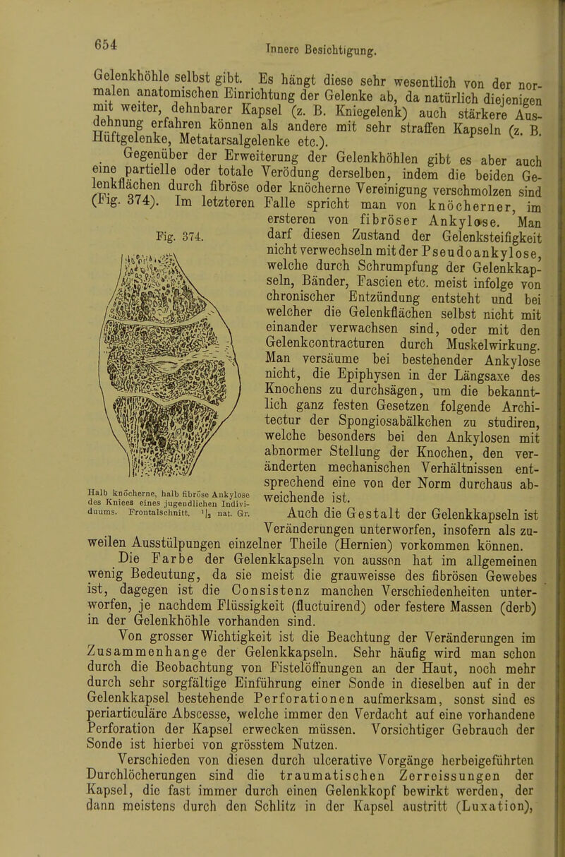 Fig. 374. Gelenkhohle selbst gibt. Es hängt diese sehr wesentlich von der nor- malen anatomischen Einrichtung der Gelenke ab, da natürlich diejenigen mit weiter dehnbarer Kapsel (z. B. Kniegelenk) auch stärkere Aus- dehnung erfahren können als andere mit sehr straffen Kapseln (z. B Hüftgelenke, Metatarsalgelenke etc.). ^ Gegenüber der Erweiterung der Gelenkhöhlen gibt es aber auch eine partielle oder totale Verödung derselben, indem die beiden Ge- lenkllachen durch fibröse oder knöcherne Vereinigung verschmolzen sind C^ig. 614:). Im letzteren Falle spricht man von knöcherner, im ersteren von fibröser Ankylose. 'Man darf diesen Zustand der Gelenksteifigkeit nicht verwechseln mitderPseudoankylose, welche durch Schrumpfung der Gelenkkap- seln, Bänder, Fascien etc. meist infolge von chronischer Entzündung entsteht und bei welcher die Gelenkflächen selbst nicht mit einander verwachsen sind, oder mit den Gelenkcontracturen durch Muskelwirkung. Man versäume bei bestehender Ankylose nicht, die Epiphysen in der Längsaxe des Knochens zu durchsägen, um die bekannt- lich ganz festen Gesetzen folgende Archi- tectur der Spongiosabälkchen zu studiren, welche besonders bei den Ankylosen mit abnormer Stellung der Knochen, den ver- änderten mechanischen Verhältnissen ent- sprechend eine von der Norm durchaus ab- weichende ist. Auch die Gestalt der Gelenkkapseln ist Veränderungen unterworfen, insofern als zu- weilen Ausstülpungen einzelner Theile (Hernien) vorkommen können. Die Farbe der Gelenkkapseln von aussen hat im allgemeinen wenig Bedeutung, da sie meist die grauweisse des fibrösen Gewebes ist, dagegen ist die Consistenz manchen Verschiedenheiten unter- werfen, je nachdem Flüssigkeit (fluctuirend) oder festere Massen (derb) in der Gelenkhöhle vorhanden sind. Von grosser Wichtigkeit ist die Beachtung der Veränderungen im Zusammenhange der Gelenkkapseln. Sehr häufig wird man schon durch die Beobachtung von Fistelöffnungen an der Haut, noch mehr durch sehr sorgfältige Einführung einer Sonde in dieselben auf in der Gelenkkapsel bestehende Perforationen aufmerksam, sonst sind es periarticuläre Abscesse, welche immer den Verdacht auf eine vorhandene Perforation der Kapsel erwecken müssen. Vorsichtiger Gebrauch der Sonde ist hierbei von grösstem Nutzen. Verschieden von diesen durch ulcerative Vorgänge herbeigeführten Durchlöcherungen sind die traumatischen Zerreissungen der Kapsel, die fast immer durch einen Gelenkkopf bewirkt werden, der dann meistens durch den Schlitz in der Kapsel austritt (Luxation), Halb knöcherne, halb fibröse Ankylose des Kniees eines jugendlichen Indivi- duums. Frontalschnitt. i|j nat, Gr.