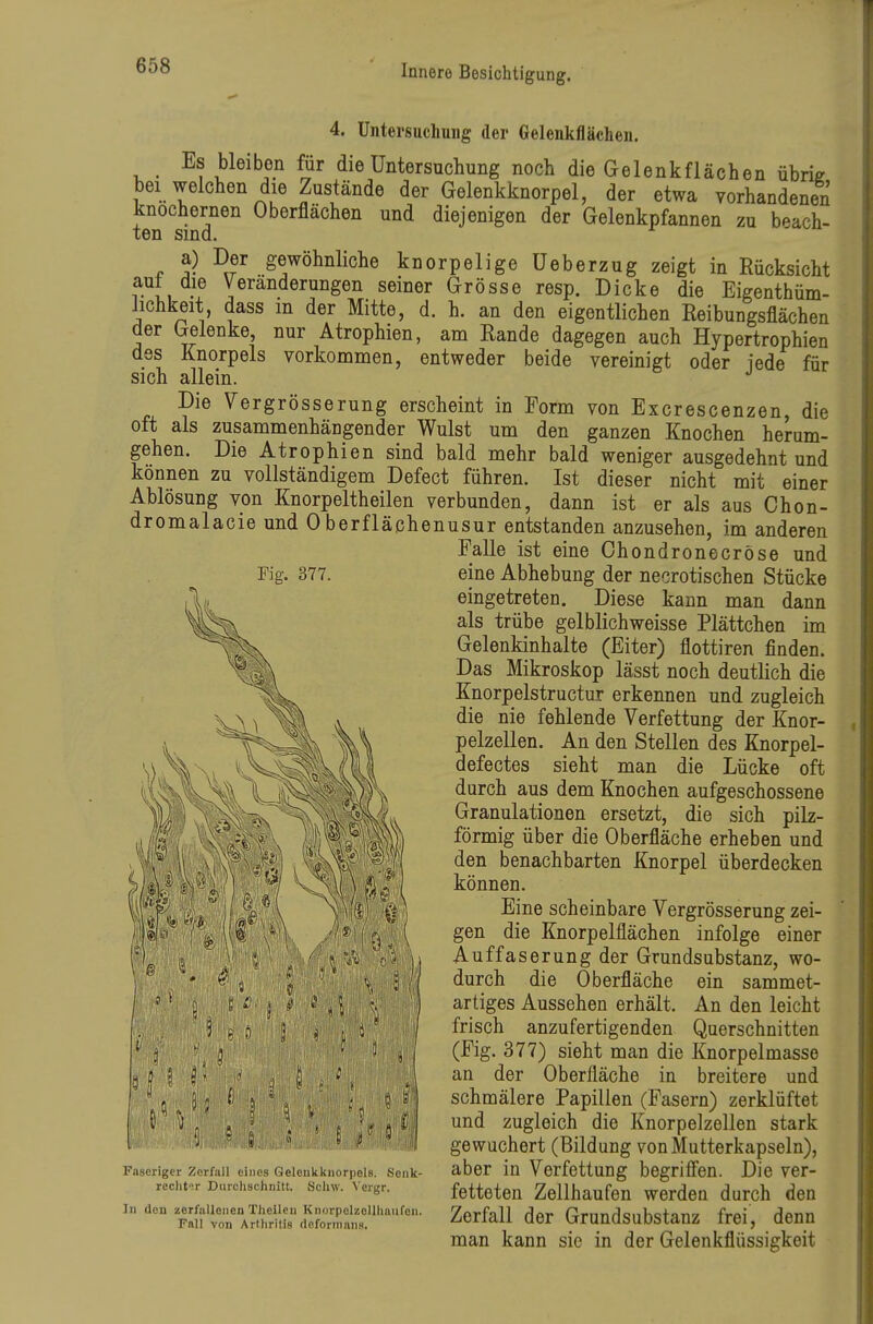 4. Untersuchung der Gelenkflächen. Es bleiben für die Untersuchung noch die Gelenkflächen übrie bei welchen die Zustände der Gelenkknorpel, der etwa vorhandenen knöchernen Oberflächen und diejenigen der Gelenkpfannen zu beach- ten sind. a) Der gewöhnliche knorpelige üeberzug zeigt in Rücksicht aut die Veränderungen seiner Grösse resp. Dicke die Eigenthüm- lichkeit dass in der Mitte, d. h. an den eigentlichen Reibungsflächen der Gelenke, nur Atrophien, am Rande dagegen auch Hypertrophien des Knorpels vorkommen, entweder beide vereinigt oder jede für sich allein. Die Vergrösserung erscheint in Form von Excrescenzen, die oft als zusammenhängender Wulst um den ganzen Knochen herum- gehen. Die Atrophien sind bald mehr bald weniger ausgedehnt und können zu vollständigem Defect führen. Ist dieser nicht mit einer Ablösung von Knorpeltheilen verbunden, dann ist er als aus Chon- dromalacie und Oberflächenusur entstanden anzusehen, im anderen Falle ist eine Chondronecröse und Fig. 377. eine Abhebung der necrotischen Stücke eingetreten. Diese kann man dann als trübe gelblichweisse Plättchen im Gelenkinhalte (Eiter) flottiren finden. Das Mikroskop lässt noch deutlich die Knorpelstructur erkennen und zugleich die nie fehlende Verfettung der Knor- pelzellen. An den Stellen des Knorpel- defectes sieht man die Lücke oft durch aus dem Knochen aufgeschossene Granulationen ersetzt, die sich pilz- förmig über die Oberfläche erheben und den benachbarten Knorpel überdecken können. Eine scheinbare Vergrösserung zei- gen die Knorpelflächen infolge einer Auffaserung der Grundsubstanz, wo- durch die Oberfläche ein sammet- artiges Aussehen erhält. An den leicht frisch anzufertigenden Querschnitten (Fig. 377) sieht man die Knorpelmasse an der Oberfläche in breitere und schmälere Papillen (Fasern) zerklüftet und zugleich die Knorpelzellen stark gewuchert (Bildung von Mutterkapseln), aber in Verfettung begrifien. Die ver- fetteten Zellhaufen werden durch den Zerfall der Grundsubstanz frei, denn man kann sie in der Gelenkflüssigkeit Faseriger Zerfall eines Gelcnkknorpels. Senk recht.r Durchschnitt. Schw. Vergr. In den zcrfiillenen Theilcn KnorpelzoUhnufen Fall von Arthritis rteforinans.