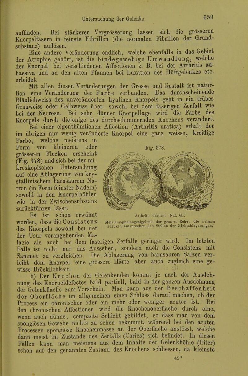 auffinden. Bei stärkerer Vergrösserung lassen sich die grösseren Knorpelfasern in feinste Fibrillen (die normalen Fibrillen der Grund- substanz) auflösen. Eine andere Veränderung endlich, welche ebenfalls in das Gebiet der Atrophie gehört, ist die bindegewebige Umwandlung, welche der Knorpel bei verschiedenen Affectionen z. B. bei der Arthritis ad- haesiva und an den alten Pfannen bei Luxation des Hüftgelenkes etc. erleidet. Mit allen diesen Veränderungen der Grösse und Gestalt ist natür- lich eine Veränderung der Farbe verbunden. Das durchscheinende Bläulichweiss des unveränderten hyalinen Knorpels geht in ein trübes Grauweiss oder Gelb weiss über, sowohl bei dem faserigen Zerfall wie bei der Necrose. Bei sehr dünner Knorpellage wird die Farbe des Knorpels durch diejenige des durchschimmernden Knochens verändert. Bei einer eigenthümlichen Affection (Arthritis uratica) erhält der im übrigen nur wenig veränderte Knorpel eine ganz weisse, kreidige Farbe, welche meistens in Form von kleineren oder grösseren Flecken erscheint (Fig. 378) und sich bei der mi- kroskopischen Untersuchung auf eine Ablagerung von kry- stallinischem harnsaurem Na- tron (in Form feinster Nadeln) sowohl in den Knorpelhöhlen wie in der Zwischensubstanz zurückführen lässt. Es ist schon erwähnt worden, dass die Consistenz des Knorpels sowohl bei der der Usur vorangehenden Ma- lacie als auch bei dem faserigen Zerfalle geringer wird. Im letzten Falle ist nicht nur das Aussehen, sondern auch die Consistenz mit Sammet zu vergleichen. Die Ablagerung von harnsauren Salzen ver- leiht dem Knorpel eine grössere Härte aber auch zugleich eine ge- wisse Bröcklichkeit. b) Der Knochen der Gelenkenden kommt je nach der Ausdeh- nung des Knorpeldefectes bald partiell, bald in der ganzen Ausdehnung der Gelenkfläche zum Vorschein. Man kann aus der Beschaffenheit der Oberfläche im allgemeinen einen Schluss daraufmachen, ob der Process ein chronischer oder ein mehr oder weniger acuter ist. Bei den chronischen Affectionen wird die Knochenoberfläche durch eine, wenn auch dünne, compacte Schicht gebildet, so dass nian von dem spongiösen Gewebe nichts zu sehen bekommt, während bei den acuten Processen spongiöse Knochenmasse an der Oberfläche anstösst, welche dann meist im Zustande des Zerfalls (Caries) sich befindet. In diesen Fällen kann man meistens aus dem Inhalte der Gelenkhöhle (Eiter) schon auf den genannten Zustand des Knochens schliessen, da kleinste 42* Fig. 378. Arthritis uratica. Nat. Gr. Metatarsophalangealgelenk der grossen Zehe; die weissen Flecken entsprechen den Stellen der Gichtnblagerungen,'