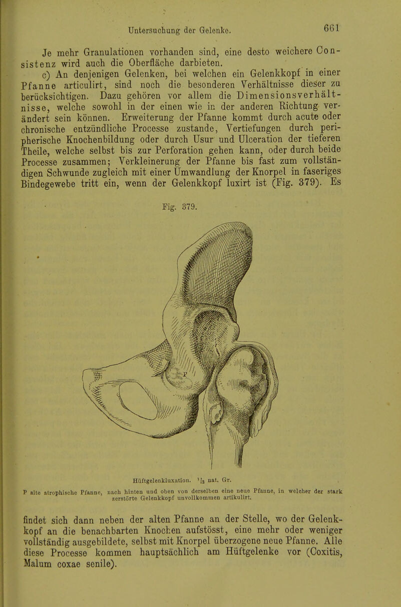 Je mehr Granulationen vorhanden sind, eine desto weichere Con- sistenz wird auch die Oberfläche darbieten. c) An denjenigen Gelenken, bei welchen ein Gelenkkopf in einer Pfanne articulirt, sind noch die besonderen Verhältnisse dieser zu berücksichtigen. Dazu gehören vor allem die Dimensionsverhält- nisse, welche sowohl in der einen wie in der anderen Richtung ver- ändert sein können. Erweiterung der Pfanne kommt durch acute oder chronische entzündliche Processe zustande, Vertiefungen durch peri- pherische Knochenbildung oder durch üsur und Ulceration der tieferen Theile, welche selbst bis zur Perforation gehen kann, oder durch beide Processe zusammen; Verkleinerung der Pfanne bis fast zum vollstän- digen Schwunde zugleich mit einer Umwandlung der Knorpel in faseriges Bindegewebe tritt ein, wenn der Gelenkkopf luxirt ist (Fig. 379). Es Fig. 379. Hüftgelenkluxatiou. '[3 nat. Gr. P alte atrophische Pfanne, nach hinten und oben von derselben eine neue Pfanne, in welcher der stark zerstörte Gelenkkopf unvollkommen artikulirt. findet sich dann neben der alten Pfanne an der Stelle, wo der Gelenk- kopf an die benachbarten Knochen aufstösst, eine mehr oder weniger vollständig ausgebildete, selbst mit Knorpel überzogene neue Pfanne. Alle diese Processe kommen hauptsächlich am Hüftgelenke vor (Coxitis, Malum coxae senile).