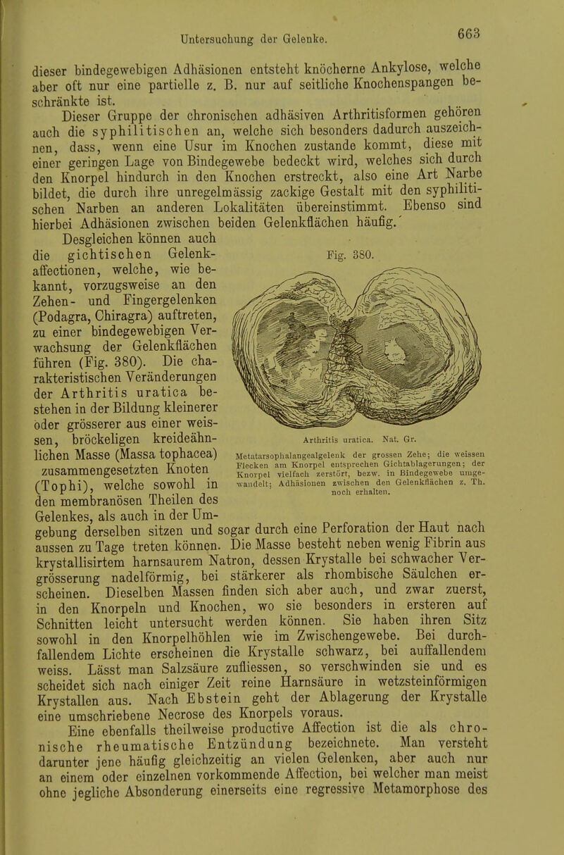 dieser bindegewebigen Adhäsionen entsteht knöcherne Ankylose, welcbe aber oft nur eine partielle z. B. nur auf seitliche Knochenspangen be- schränkte ist. Dieser Gruppe der chronischen adhäsiven Arthritisformen gehören auch die syphilitischen an, welche sich besonders dadurch auszeich- nen, dass, wenn eine Usur im Knochen zustande kommt, diese mit einer geringen Lage von Bindegewebe bedeckt wird, welches sich durch den Knorpel hindurch in den Knochen erstreckt, also eine Art Narbe bildet, die durch ihre unregelmässig zackige Gestalt mit den syphiliti- schen Narben an anderen Lokalitäten übereinstimmt. Ebenso sind hierbei Adhäsionen zwischen beiden Gelenkflächen häufig.' Desgleichen können auch die gichtischen Gelenk- Fig. 380. affectionen, welche, wie be- kannt, vorzugsweise an den Zehen- und Fingergelenken (Podagra, Chiragra) auftreten, zu einer bindegewebigen Ver- wachsung der Gelenkflächen führen (Fig. 380). Die cha- rakteristischen Veränderungen der Arthritis uratica be- stehen in der Bildung kleinerer öder grösserer aus einer weis- sen , bröckeligen kreideähn- lichen Masse (Massa tophacea) zusammengesetzten Knoten (Tophi), welche sowohl in den membranösen Theilen des Gelenkes, als auch in der Um- . rr ± x. gebung derselben sitzen und sogar durch eine Perforation der Haut nach aussen zu Tage treten können. Die Masse besteht neben wenig Fibrin aus krystallisirtem harnsaurem Natron, dessen Krystalle bei schwacher Ver- grösserung nadeiförmig, bei stärkerer als rhombische Säulchen er- scheinen. Dieselben Massen finden sich aber auch, und zwar zuerst, in den Knorpeln und Knochen, wo sie besonders in ersteren auf Schnitten leicht untersucht werden können. Sie haben ihren Sitz sowohl in den Knorpelhöhlen wie im Zwischengewebe. Bei durch- fallendem Lichte erscheinen die Krystalle schwarz, bei auffallendem weiss. Lässt man Salzsäure zufliessen, so verschwinden sie und es scheidet sich nach einiger Zeit reine Harnsäure in wetzsteinförmigen Krystallen aus. Nach Ebstein geht der Ablagerung der Krystalle eine umschriebene Necrose des Knorpels voraus. Eine ebenfalls theilweise productive Affection ist die als chro- nische rheumatische Entzündung bezeichnete. Man versteht darunter jene häufig gleichzeitig an vielen Gelenken, aber auch nur an einem oder einzelnen vorkommende Affection, bei welcher man meist ohne jegliche Absonderung einerseits eine regressive Metamorphose dos Arthritis uratica. Nat. Gr. Metatarsophalangealgeleiilc der grossen Zehe; die weissen Flecken am Knorpel entsprechen Giohtablagerungen; der Knorpel vielfach zerstört, bezw. in Bindegewebe umge- wandelt; Adhäsionen zwischen den Gelenkliächen z. Th. noch erhalten.