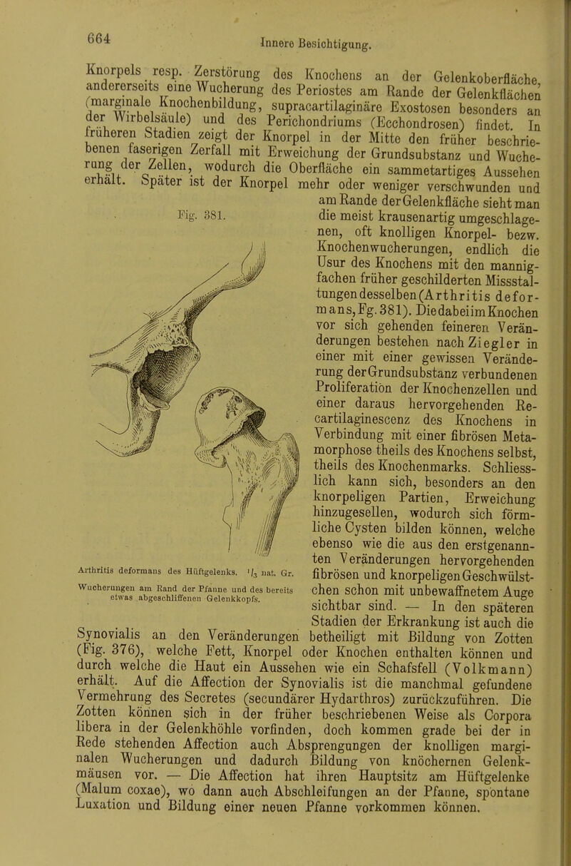 Knorpels resp. Zerstörung des Knochens an der Gelenkoberfläche andererseits eine Wucherung des Periostes am Rande der Gelenkfiächen rmarginale Knochenbildung, supracartilaginäre Exostosen besonders an der Wirbelsaule) und des Perichondriums (Ecchondrosen) findet In früheren Stadien zeigt der Knorpel in der Mitte den früher beschrie- benen faserigen Zerfall mit Erweichung der Grundsubstanz und Wuche- ^^u ^ i®'- 7?durch die Oberfläche ein sammetartiges Aussehen erhalt, bpater ist der Knorpel mehr oder weniger verschwunden und am Rande der Gelenkfläche sieht man l^ig- 381. die meist krausenartig umgeschlage- nen, oft knolligen Knorpel- bezw. Knochenwucherungen, endlich die Usur des Knochens mit den mannig- fachen früher geschilderten Missstal- tungen desselben (Arthritis defor- mans,Fg.381). Die dabei im Knochen vor sich gehenden feineren Verän- derungen bestehen nach Ziegler in einer mit einer gewissen Verände- rung der Grundsubstanz verbundenen Proliferatiön der Knochenzellen und einer daraus hervorgehenden Re- cartilaginescenz des Knochens in Verbindung mit einer fibrösen Meta- morphose theils des Knochens selbst, theils des Knochenmarks. Schliess- lich kann sich, besonders an den knorpeligen Partien, Erweichung hinzugesellen, wodurch sich förm- liche Cysten bilden können, welche ebenso wie die aus den erstgenann- ten Veränderungen hervorgehenden fibrösen und knorpeligen Geschwülst- chen schon mit unbewaffnetem Auge sichtbar sind. — In den späteren Stadien der Erkrankung ist auch die Synovialis an den Veränderungen betheiligt mit Bildung von Zotten (Fig. 376), welche Fett, Knorpel oder Knochen enthalten können und durch welche die Haut ein Aussehen wie ein Schafsfell (Volkmann) erhält. Auf die Affection der Synovialis ist die manchmal gefundene Vermehrung des Secretes (secundärer Hydarthros) zurückzuführen. Die Zotten körinen sich in der früher beschriebenen Weise als Corpora libera in der Gelenkhöhle vorfinden, doch kommen grade bei der in Rede stehenden Affection auch Absprengungen der knolligen margi- nalen Wucherungen und dadurch Bildung von knöchernen Gelenk- mäusen vor. — Die Affection hat ihren Hauptsitz am Hüftgelenke (Malum coxae), wo dann auch Abschleifungen an der Pfanne, spontane Luxation und Bildung einer neuen Pfanne vorkommen können. Arthritis deformaiis des Hüftgelenks. ' jiat. Gr. Wucheruugen am Rand der Pfanne und des bereits etwas abgeschlififenen Gelenkkopfs.