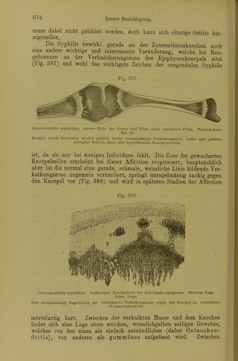 muss dabei nicht gebildet werden, doch kann sich eiterige Ostitis hin- zugesellen. Die Syphilis bewirkt gerade an den Extremitätenknochen noch eine andere wichtige und interessante Veränderung, welche bei Neu- geborenen an der Verknöcherungszone des Epiphysenknorpels sitzt (Fig. 387) und wohl das wichtigste Zeichen der congenitalen Syphilis Fig. 387. Osteochondritis syphilitica, unteres Ende des Fenuir und Tibia eines inacerirten Fötus. Front-ilgchnitt Nat. Gr. Knorpel durch Imbibition dunkel gefärbt, breite unregelmässige Verkalknngszone, breite hell gefärbte osteogene Schicht, dann sehr hyperämische Knochenschiclit. ist, da sie nur bei wenigen Individuen fehlt. Die Zone der gewucherten Knorpelzellen erscheint bei dieser Affection vergrössert, hauptsächlich aber ist die normal eine gerade, schmale, weissliche Linie bildende Ver- kalkungszone ungemein verbreitert, springt unregelmässig zackig gegen den Knorpel vor (Fig. 388) und wird in späteren Stadien der Affection Fig. 388. Osteochondritis syphilitica. Senkrechter Durchschnitt der Knochenknorpelgrenze. Frisches Präp. Schw. Vergr. Sehr uiiregelmässige Begrenzung der verbreiterten Verkalkungszone gegen den Knorpel zu. verbreiterte Wuchern Iigsschicht. mörtelartig hart. Zwischen der verkalkten Masse und dem Knochen findet sich eine Lage eines weichen, weisslichgelben zelligen Gewebes, welches von den einen als einfach entzündliches (daher Osteochon- dritis), von anderen als gummöses aufgefasst wird. Zwischen